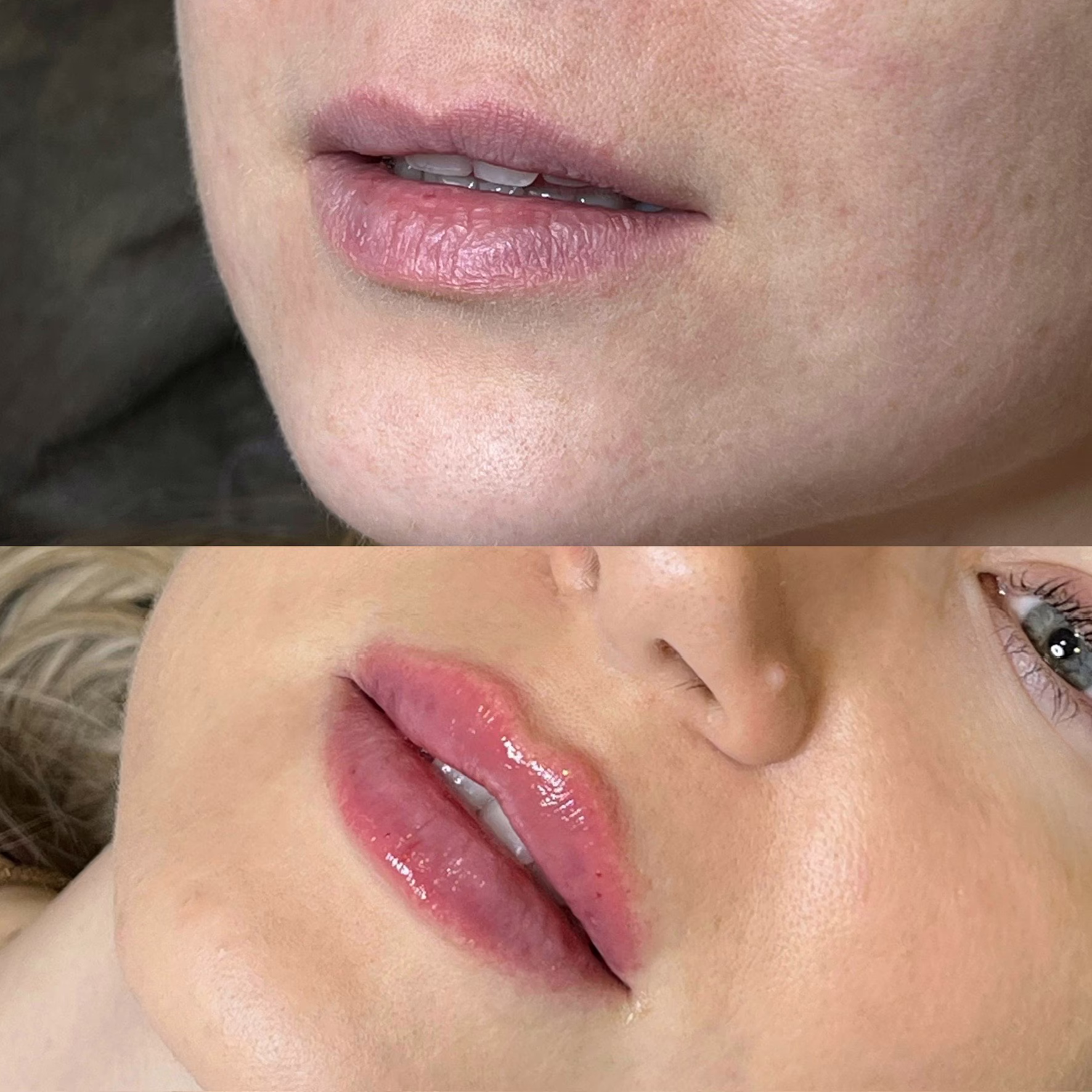 Naturalne modelowanie ust na płasko Poznań - efekt nawilżenia i subtelnej objętości przed i po zabiegu kwasem hialuronowym