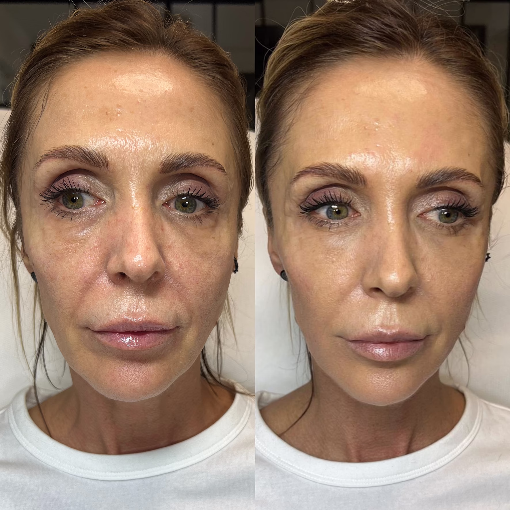 Naturalny lifting twarzy i poprawa owalu po zastosowaniu stymulatorów tkankowych. Zagęszczenie wiotkiej skóry i uniesienie tkanek u dojrzałej osoby przed i po serii zabiegów.