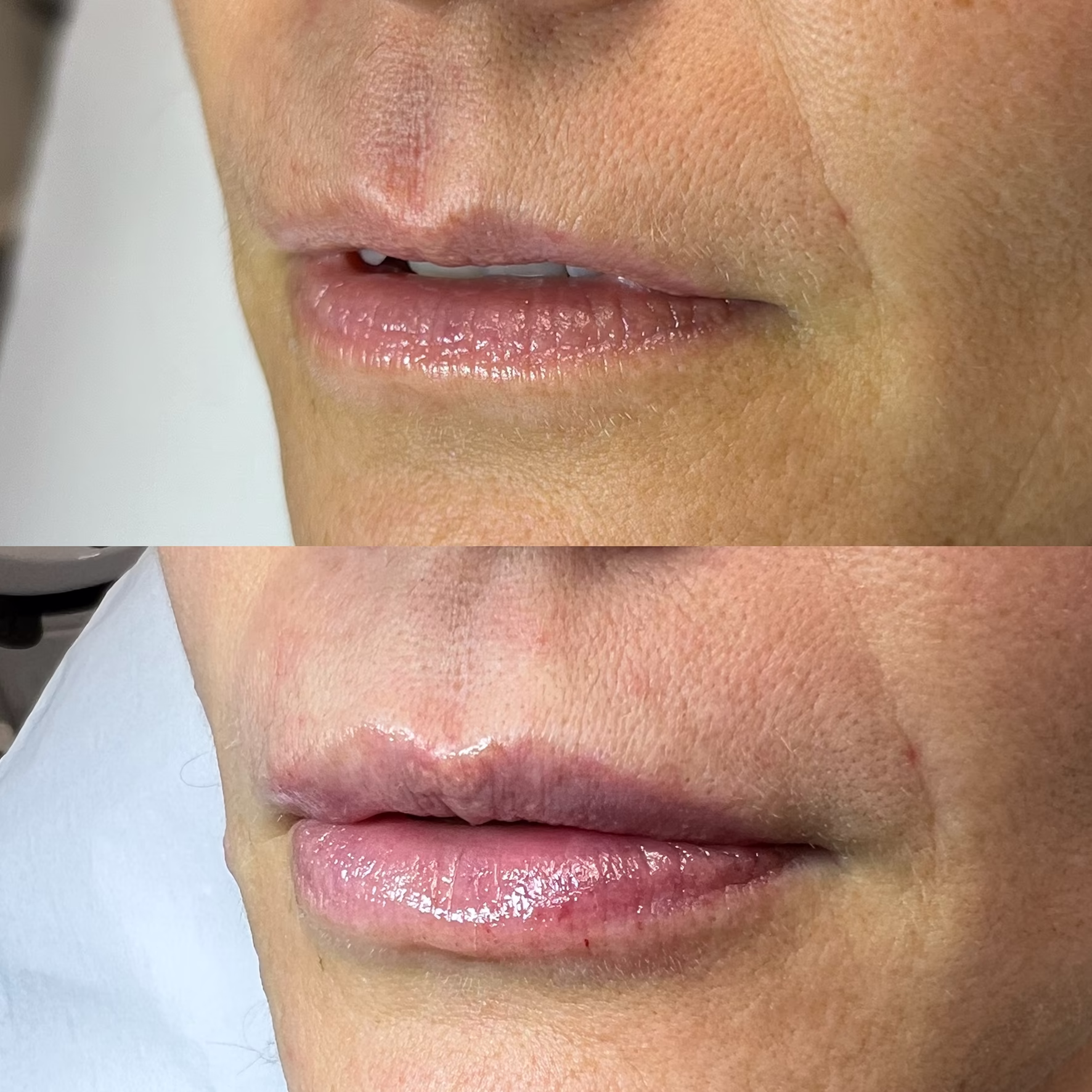 Naturalne modelowanie ust kwasem hialuronowym u dojrzałej osoby. Efekt wygładzenia struktury warg i uniesienia kącików ust przed i po zabiegu u Izabeli Malendowskiej.