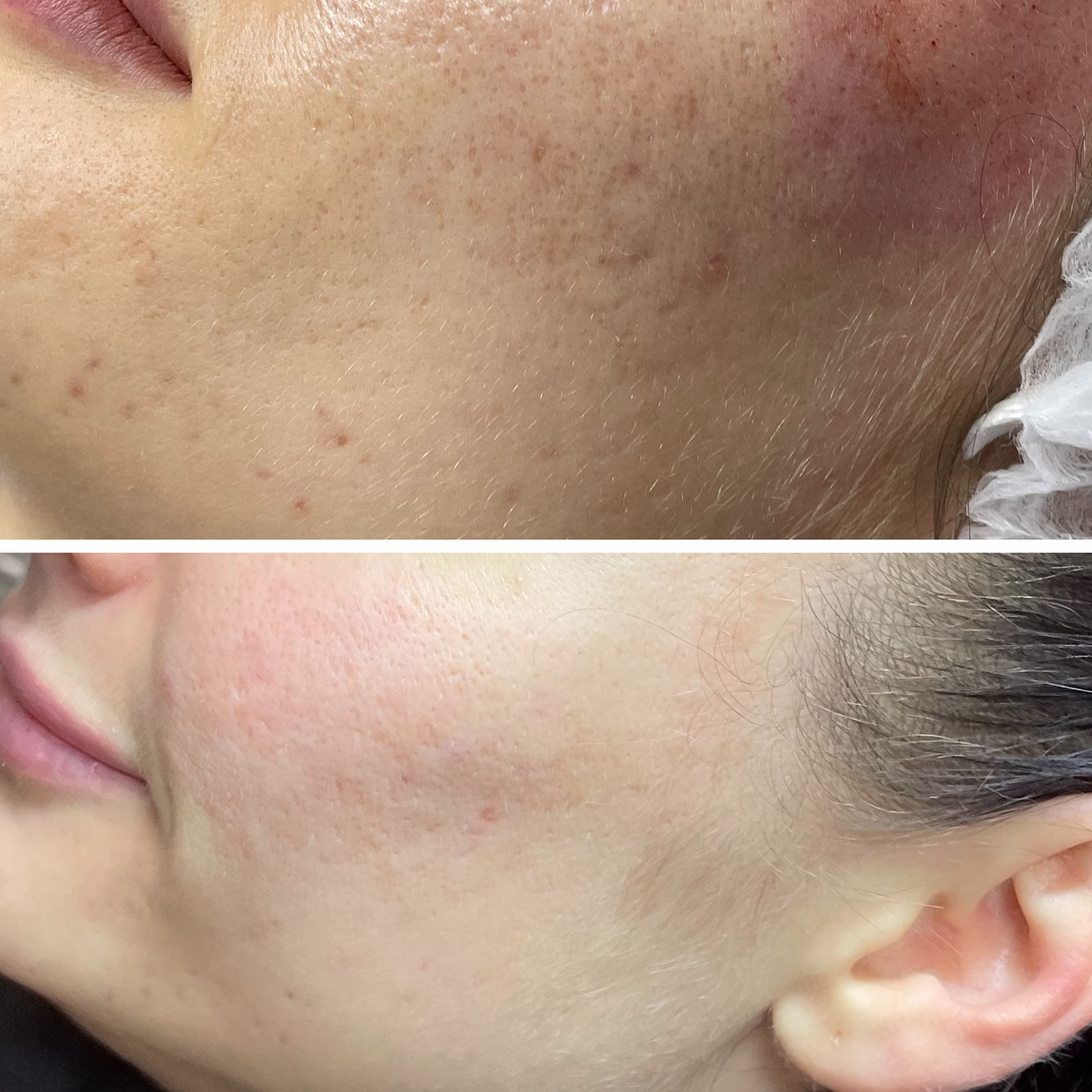 Redukcja trądziku i stanów zapalnych. Efekt terapii łączonej Dermapen z peelingiem kwasowym – wyciszenie zmian i regeneracja skóry