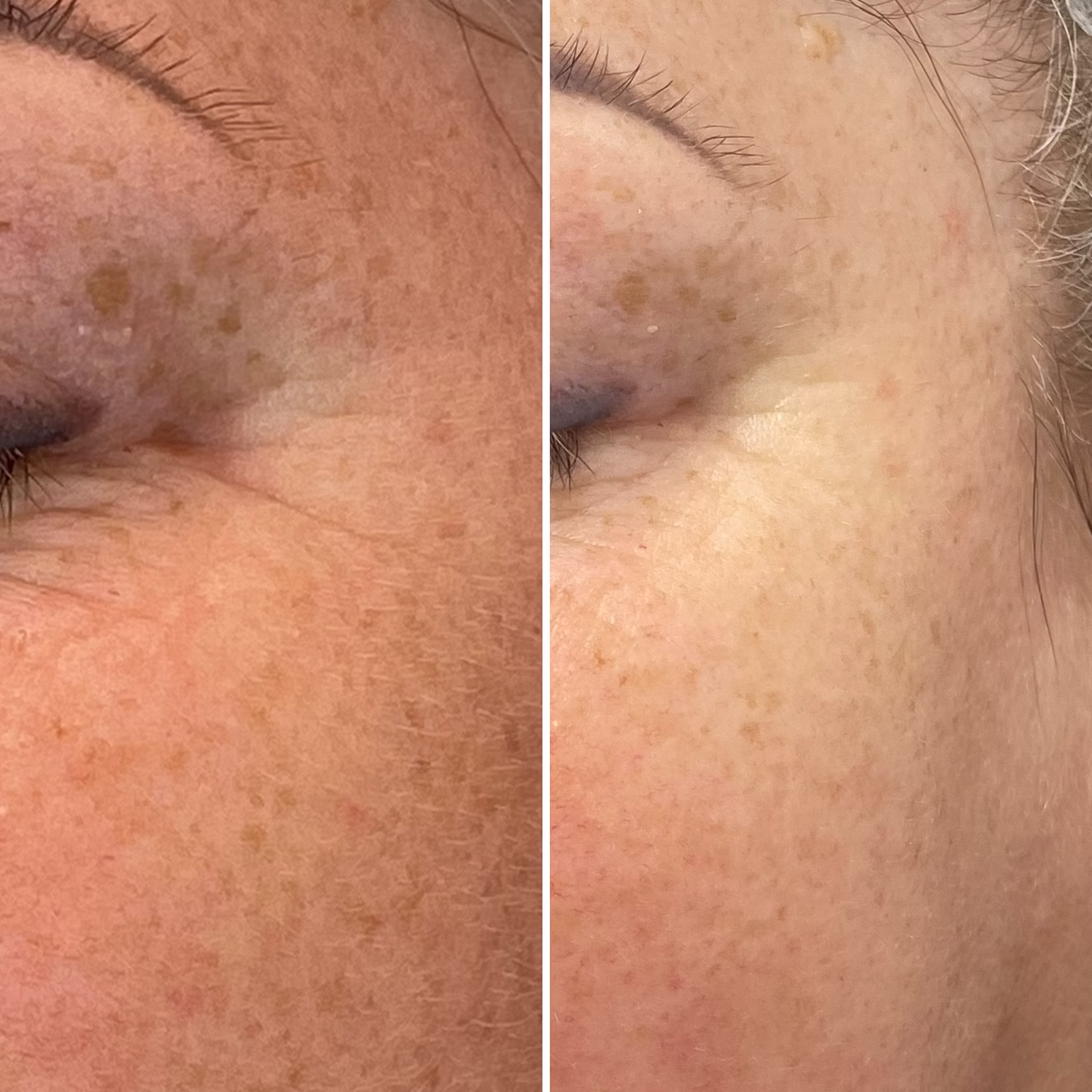 Redukcja zmarszczek okolic oka „kurze łapki” i poprawa napięcia skóry. Efekt po zabiegu mezoterapii mikroigłowej