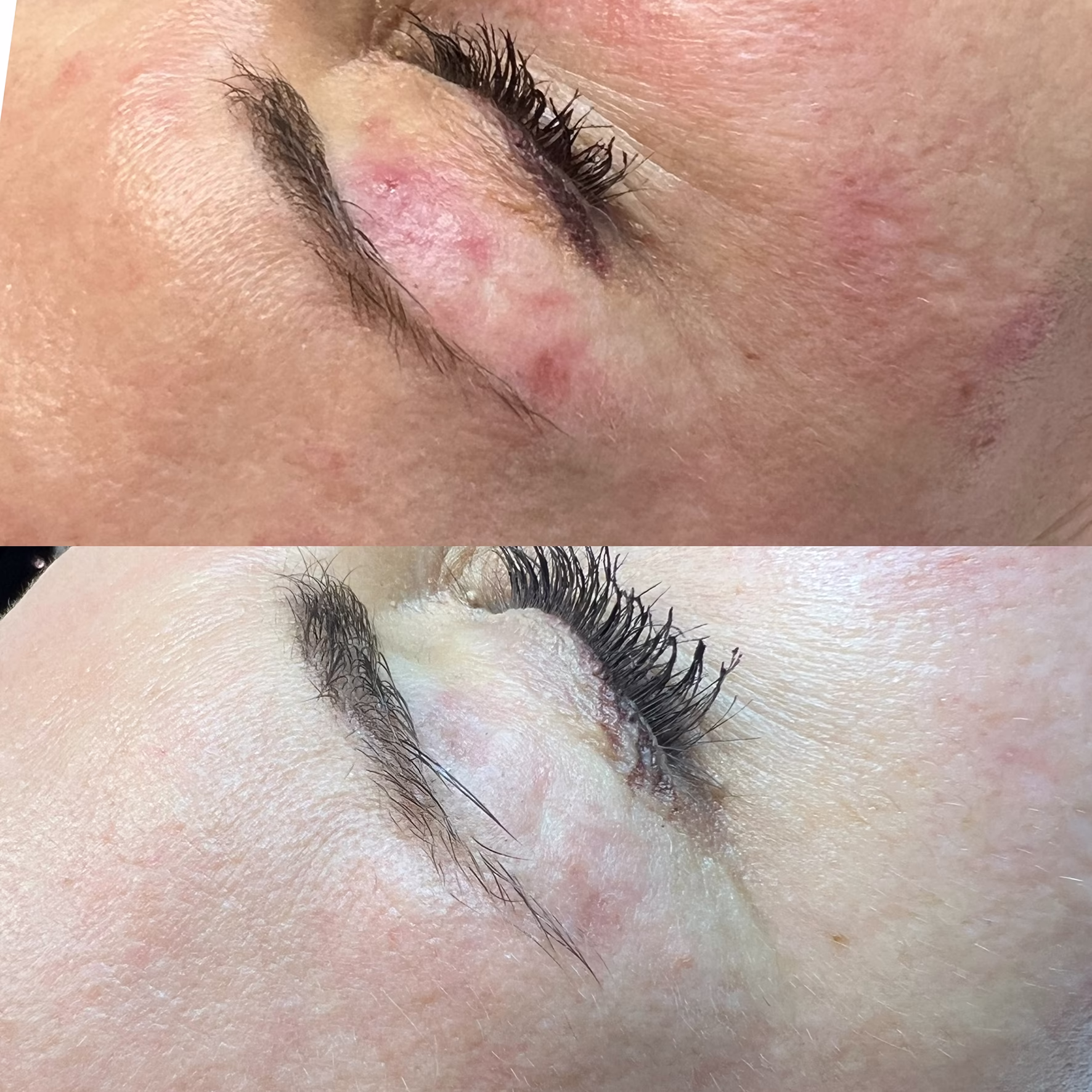 Redukcja aktywnego trądziku. Efekt zabiegu Dermapen 4.0 – wyciszenie zmian i regeneracja skóry.