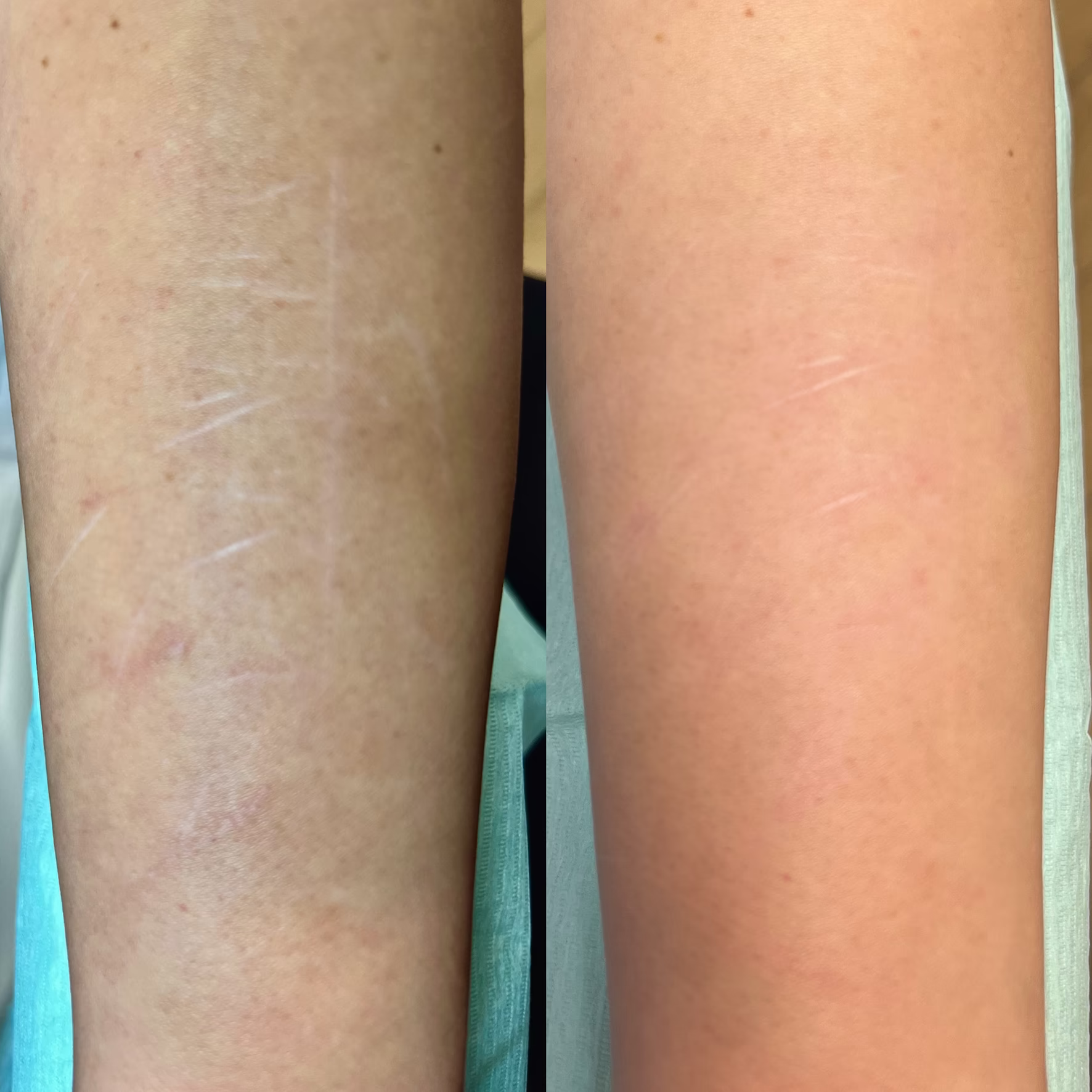 Usuwanie blizn na przedramieniu za pomocą mikronakłuwania frakcyjnego Dermapen 4.0. Efekt rozjaśnienia i wygładzenia struktury blizny przed i po