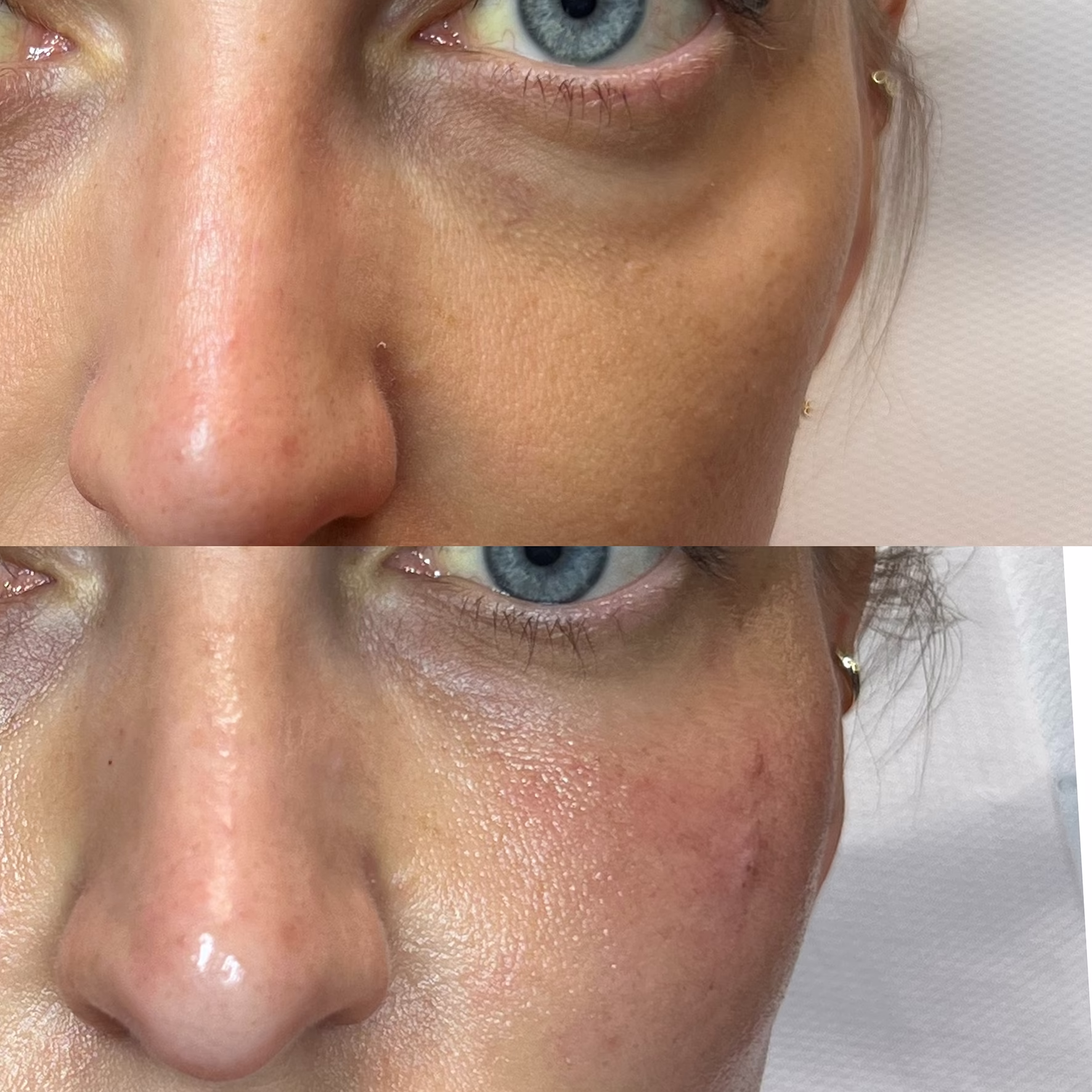 Wypełnienie doliny łez i redukcja cieni pod oczami kwasem polimlekowym Juvelook. Efekt naturalnego odświeżenia spojrzenia przed i po zabiegu w Poznaniu