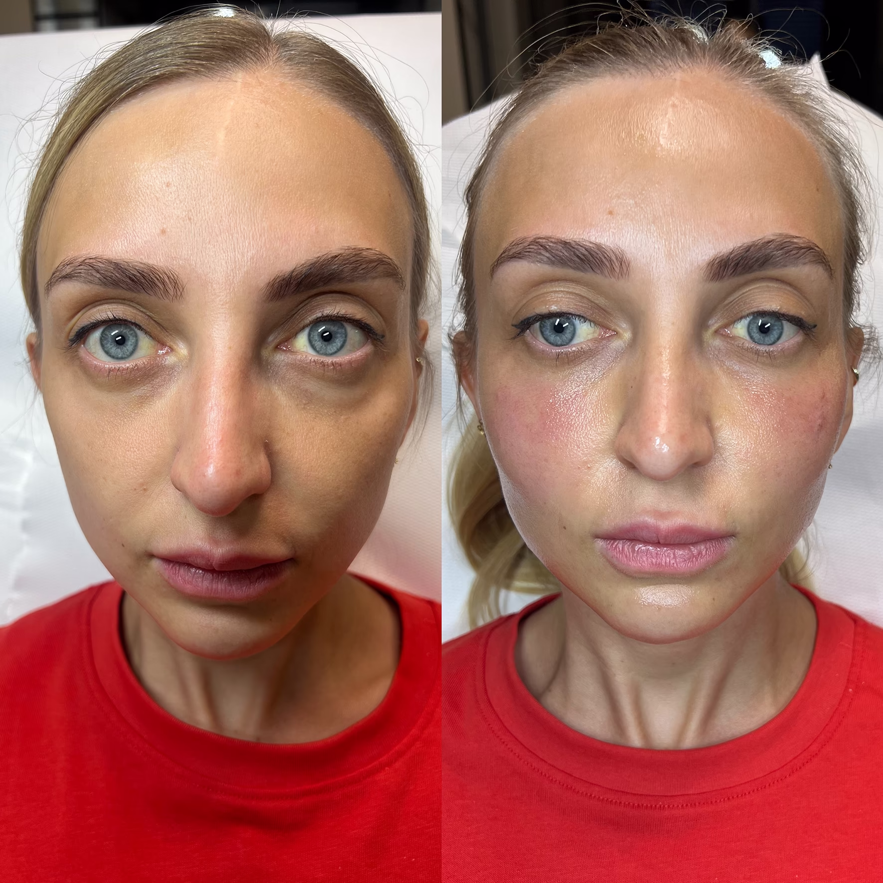 Efekt biostymulacji kwasem polimlekowym Juvelook u młodszej klientki. Widoczne rozświetlenie cery, redukcja cieni pod oczami i poprawa struktury skóry przed i po zabiegu.