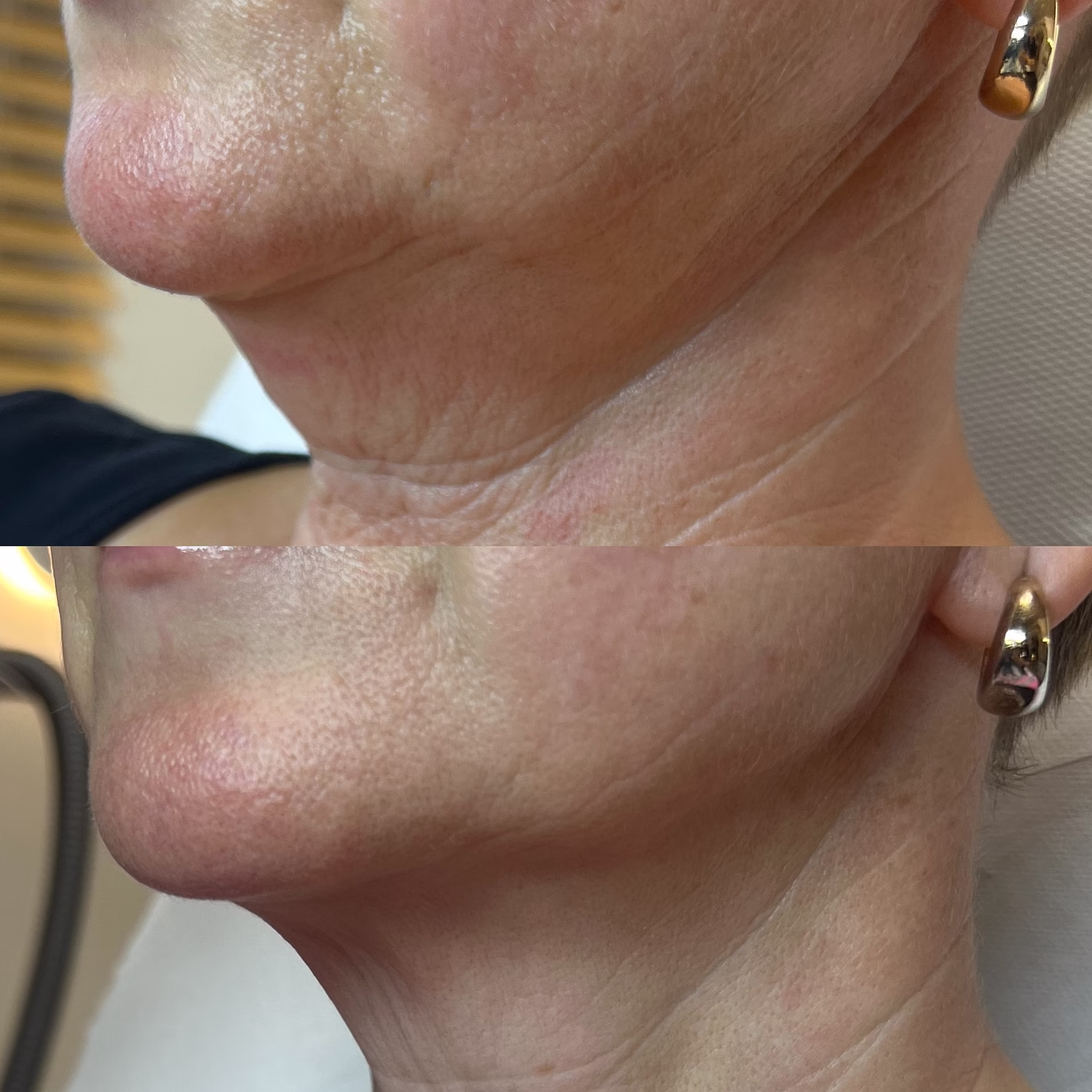 Lifting wiotkiej skóry podbródka i poprawa owalu twarzy kwasem polimlekowym Lenisna. Widoczne zagęszczenie struktury skóry i redukcja zmarszczek u dojrzałej osoby