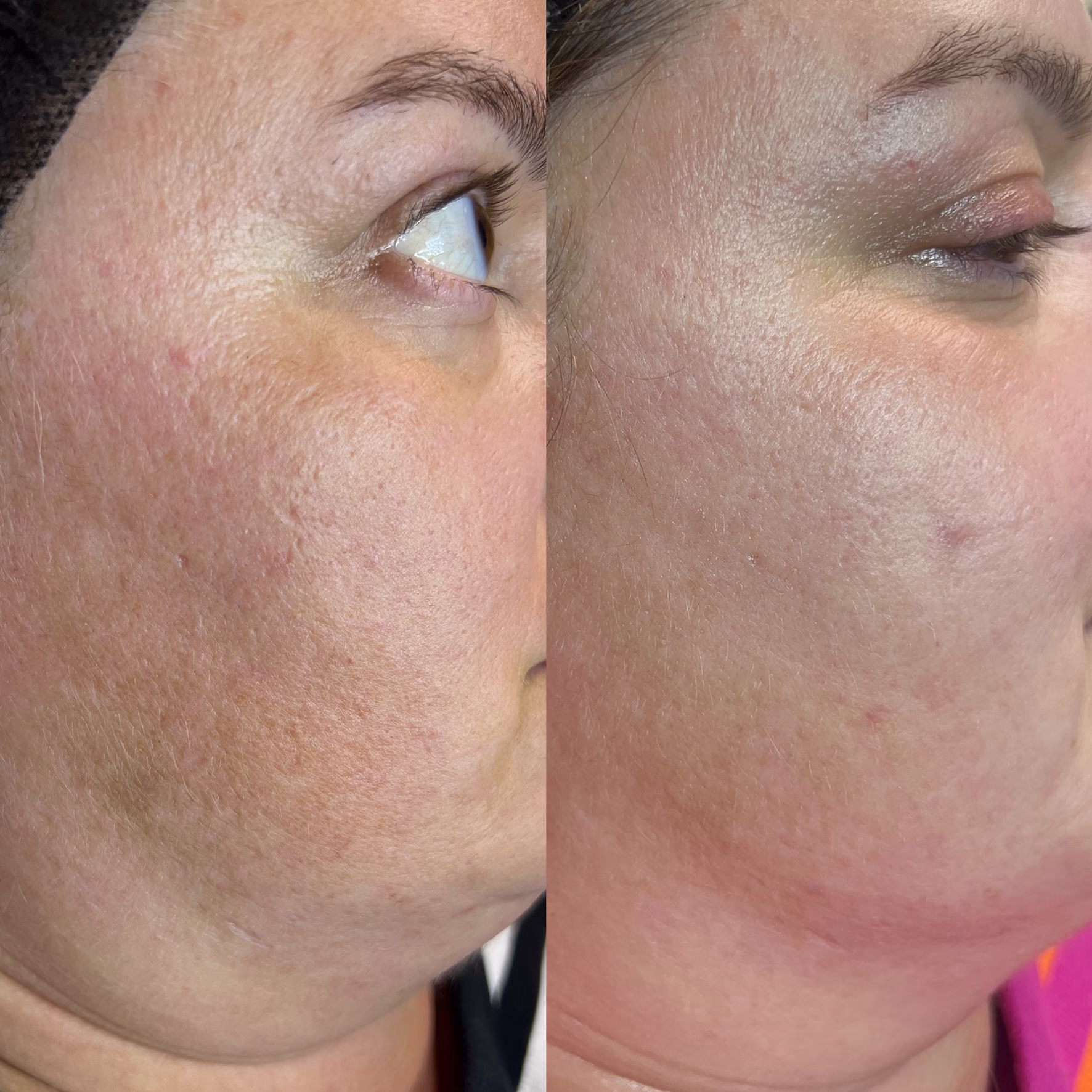 Widoczne po miesiącu zabiegu zagęszczenie skóry i poprawa napięcia owalu twarzy. Efekt Baby Face.