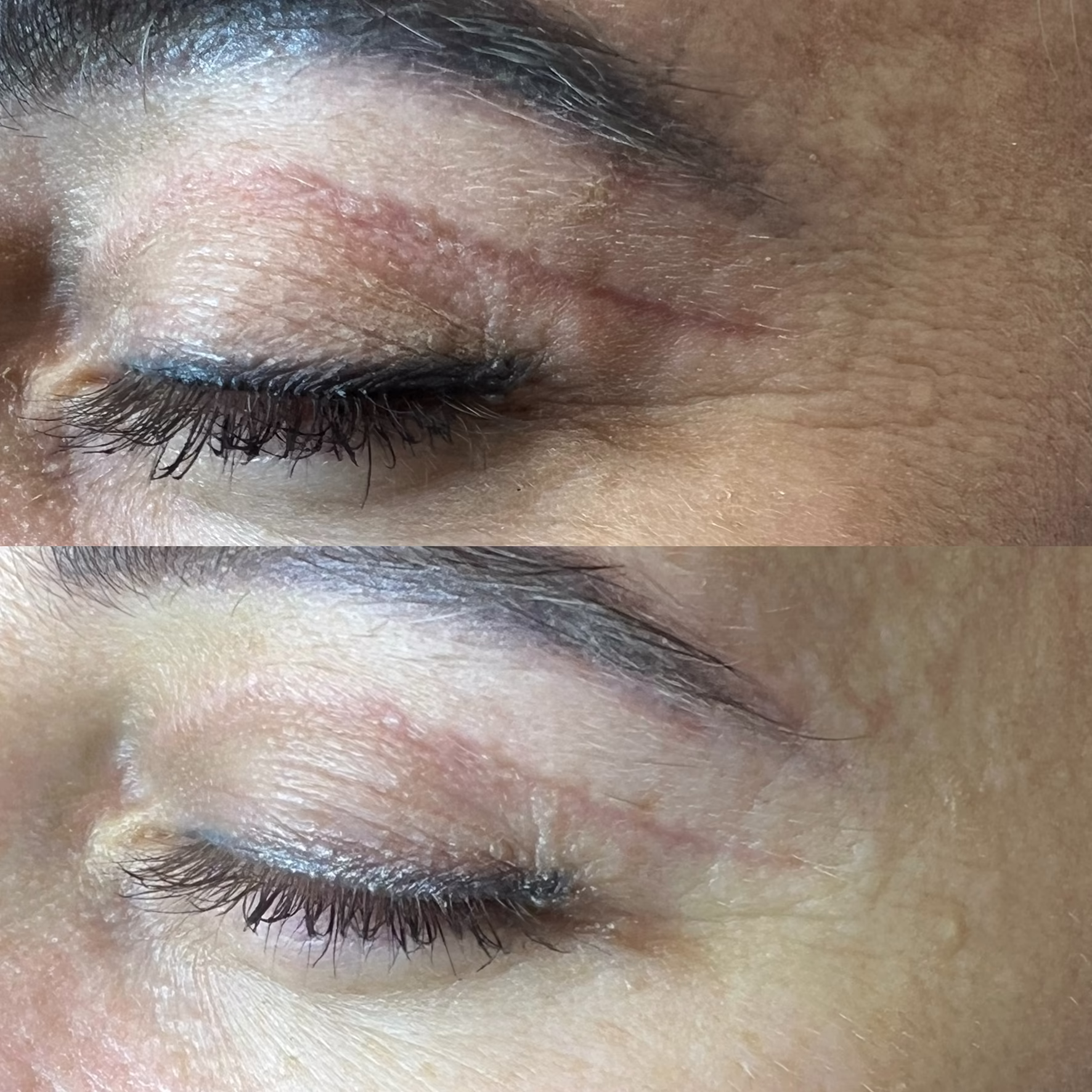 Laserowa blizny powiek bez skalpela. Porównanie przed i po zabiegu laserem tulowym GentleFrax PRO – wygładzenie i napięcie wiotkiej skóry powiek