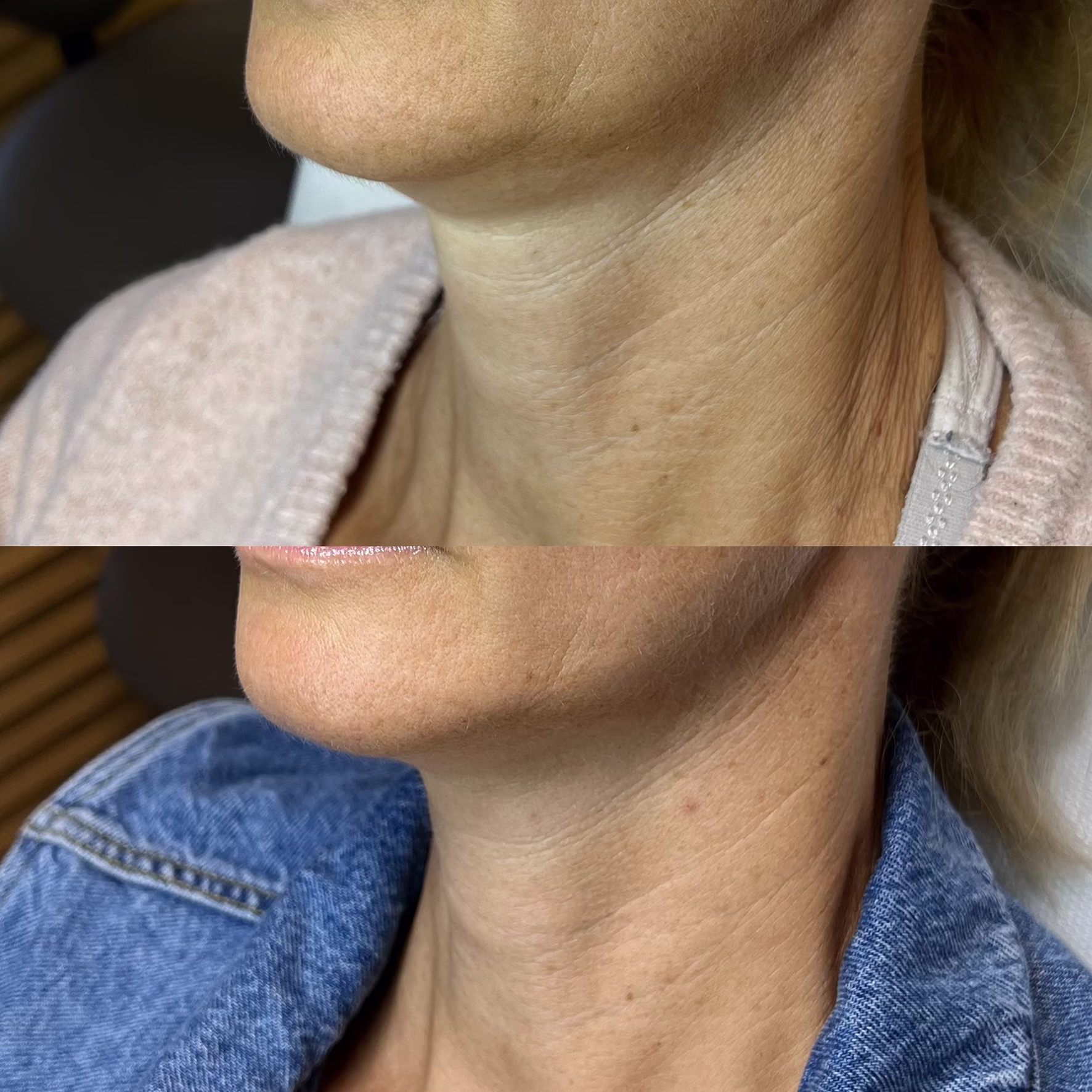 „Laserowe ujędrnianie skóry szyi – efekty przed i po. Redukcja poziomych zmarszczek, zagęszczenie wiotkiej skóry i poprawa napięcia w okolicach podbródka dzięki technologii tulowej.