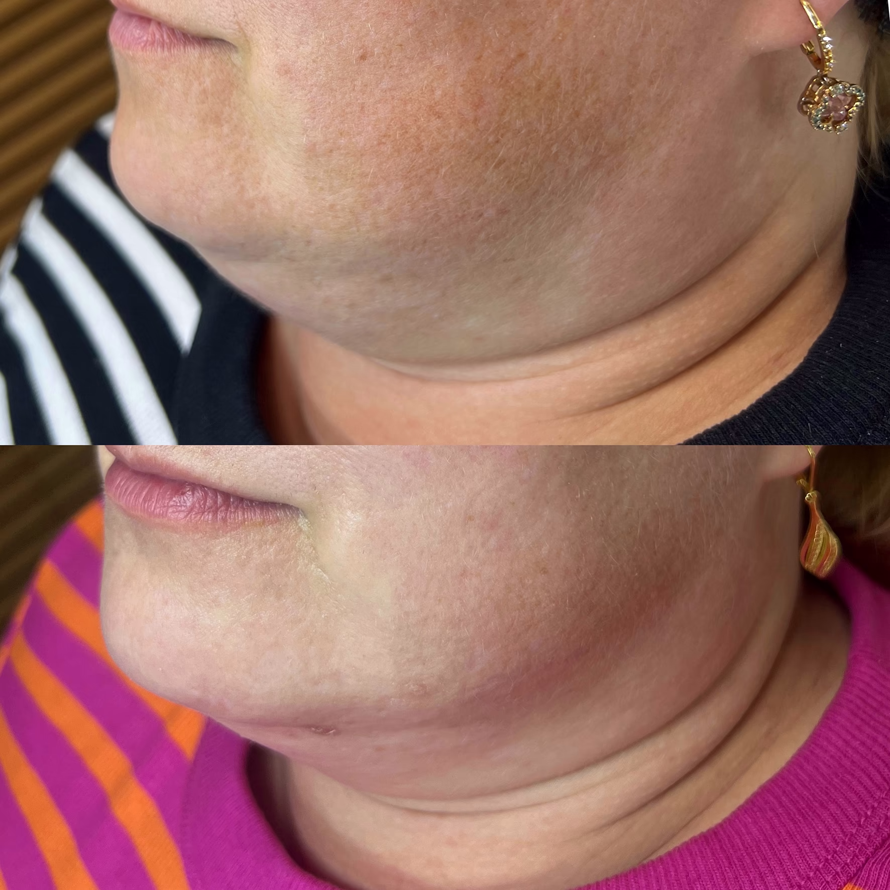 Laserowe zagęszczanie wiotkiej skóry szyi i podbródka. Poprawa napięcia, redukcja wiotkości i wygładzenie struktury dzięki głębokiej stymulacji laserem Er:Glass