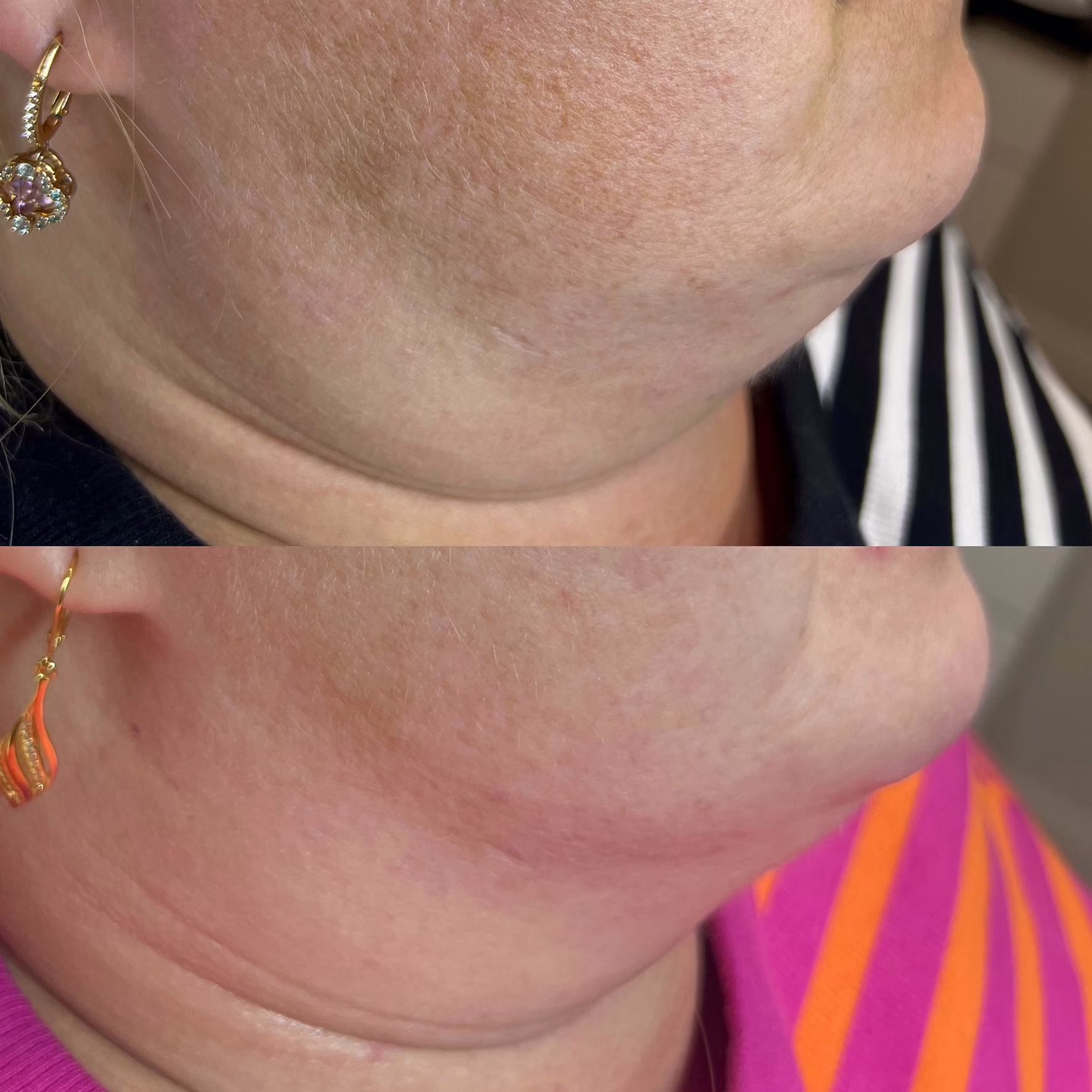 Laserowe zagęszczanie wiotkiej skóry szyi i podbródka. Poprawa napięcia, redukcja wiotkości i wygładzenie struktury dzięki głębokiej stymulacji laserem Er:Glass