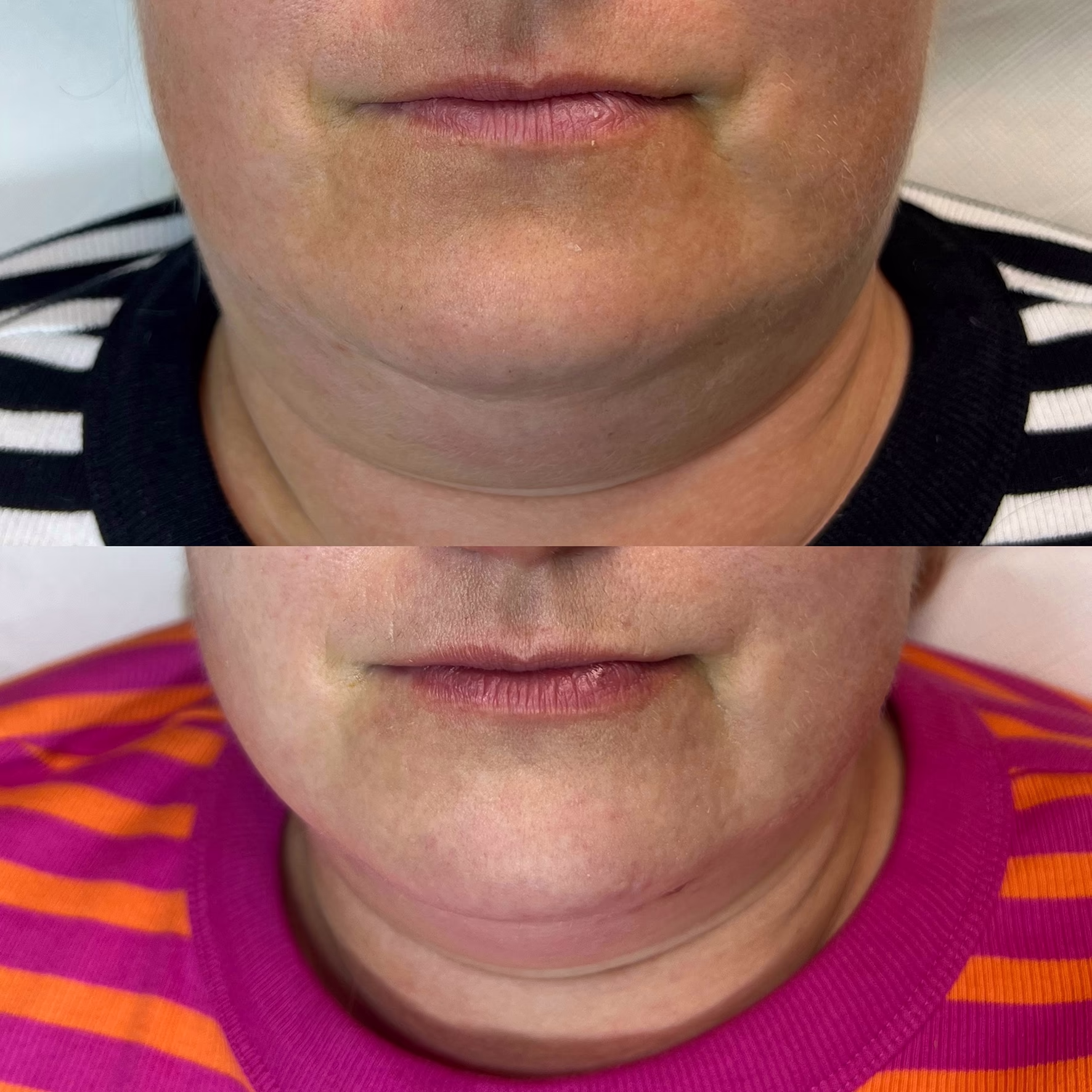 Laserowe zagęszczanie wiotkiej skóry szyi i podbródka. Poprawa napięcia, redukcja wiotkości i wygładzenie struktury dzięki głębokiej stymulacji laserem Er:Glass