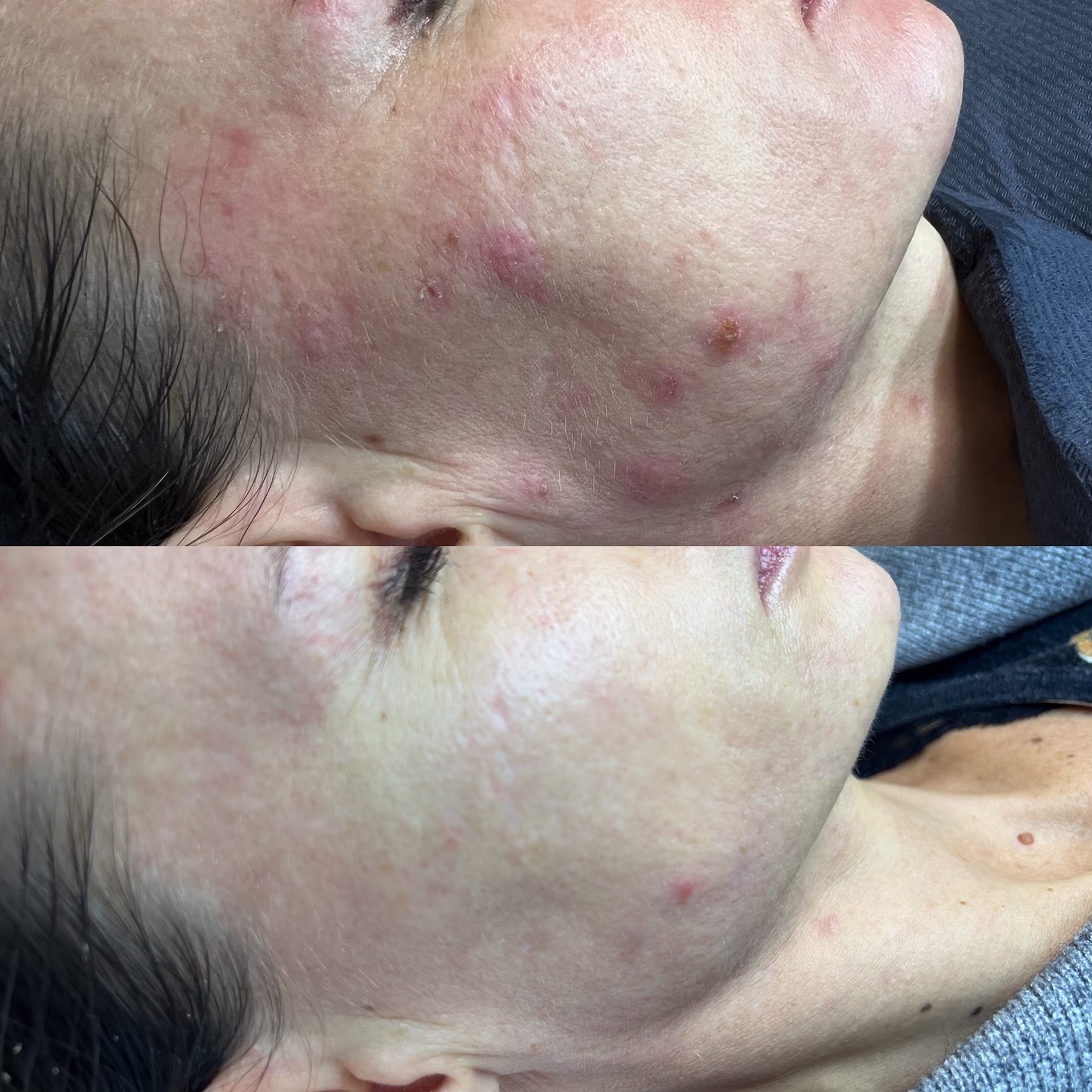 Redukcja aktywnego trądziku i stanów zapalnych. Efekt zabiegu Dermapen 4.0– wyciszenie zmian i regeneracja skóry.