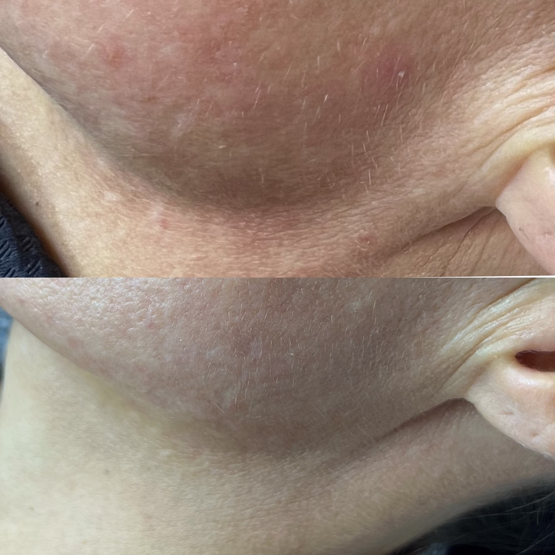 Poprawa struktury i tekstury skóry w terapii przeciwtrądzikowej. Efekt gładkiej skóry po zabiegu Dermapen w gabinecie Malendowska Aesthetic.