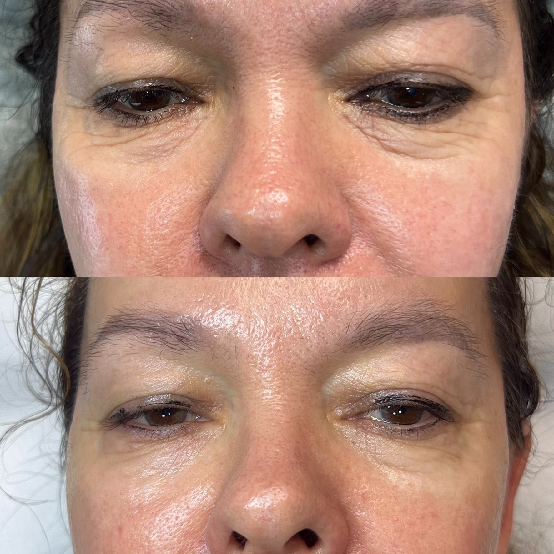 Niechirurgiczny lifting okolic oka (foxy eyes) przy użyciu nici liftingujących. Efekt uniesienia łuku brwiowego i otwarcia spojrzenia przed i po zabiegu w Poznaniu.