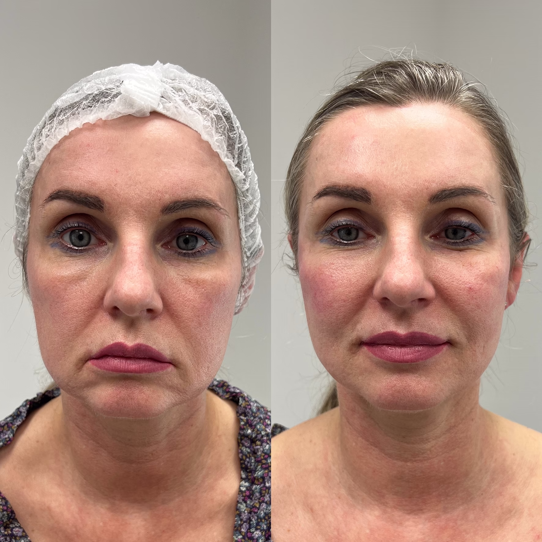 Naturalny lifting twarzy i odbudowa objętości u dojrzałej pacjentki. Efekt uniesienia owalu i redukcji bruzd marionetki przed i po zabiegu