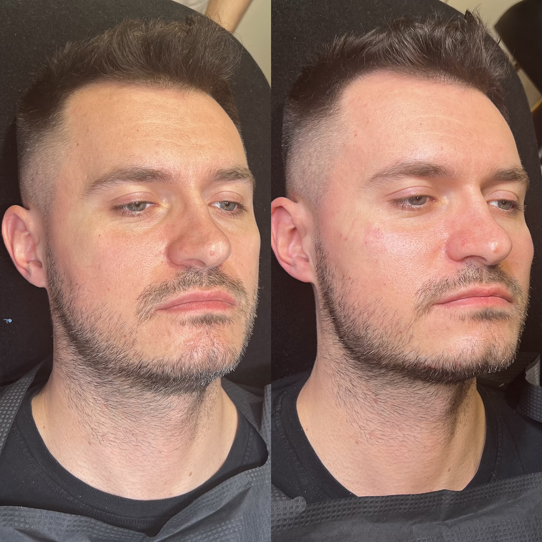 Modelowanie męskiej twarzy kwasem hialuronowym. Efekt podkreślenia konturu żuchwy i brody, nadający twarzy zdecydowany, męski charakter przed i po zabiegu.