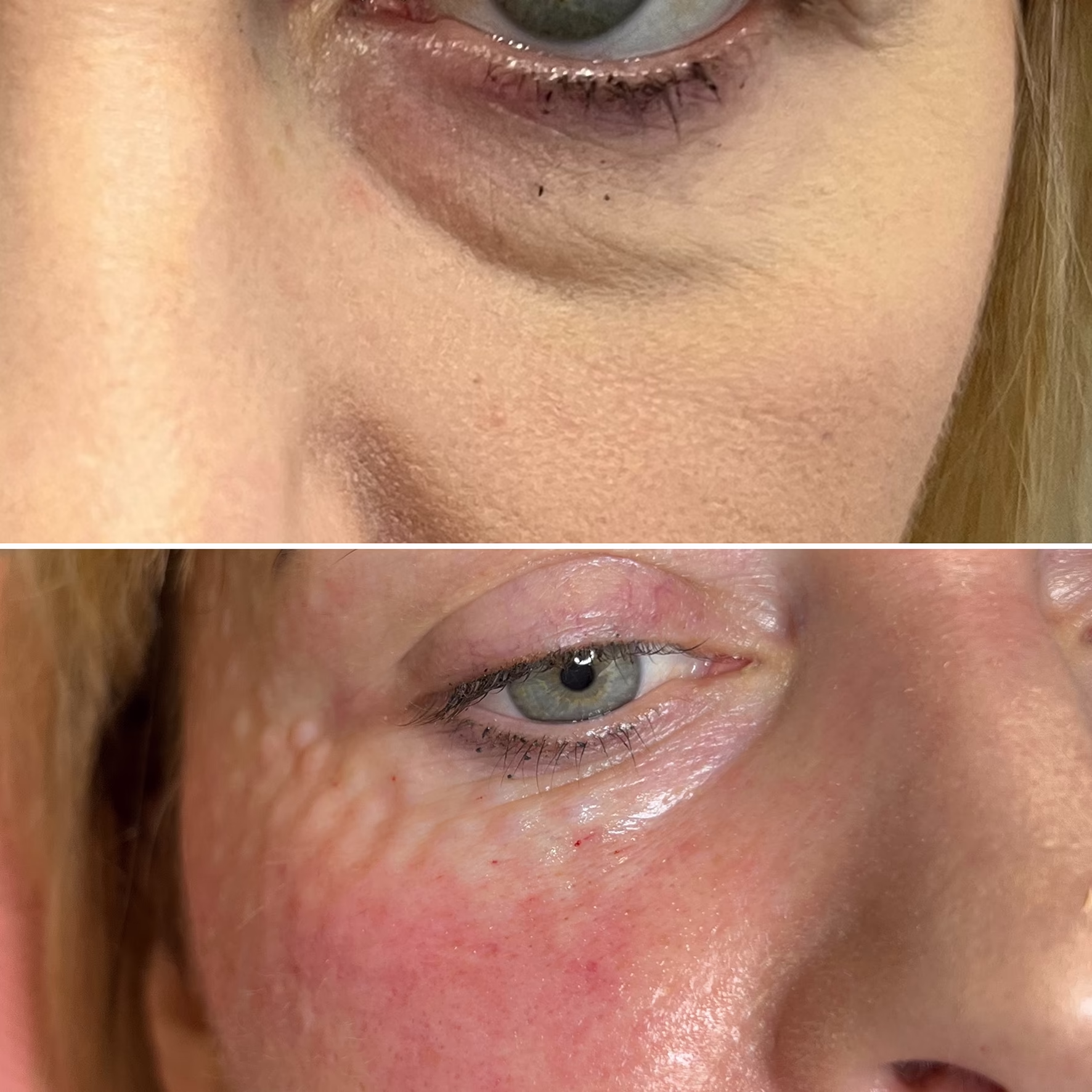 Rozjaśnienie cieni i głębokie nawilżenie okolicy oka. Efekt przed i bezpośrednio po zabiegu mezoterapii igłowej w gabinecie Malendowska Aesthetic. Widoczne pożądane depozyty preparatu.