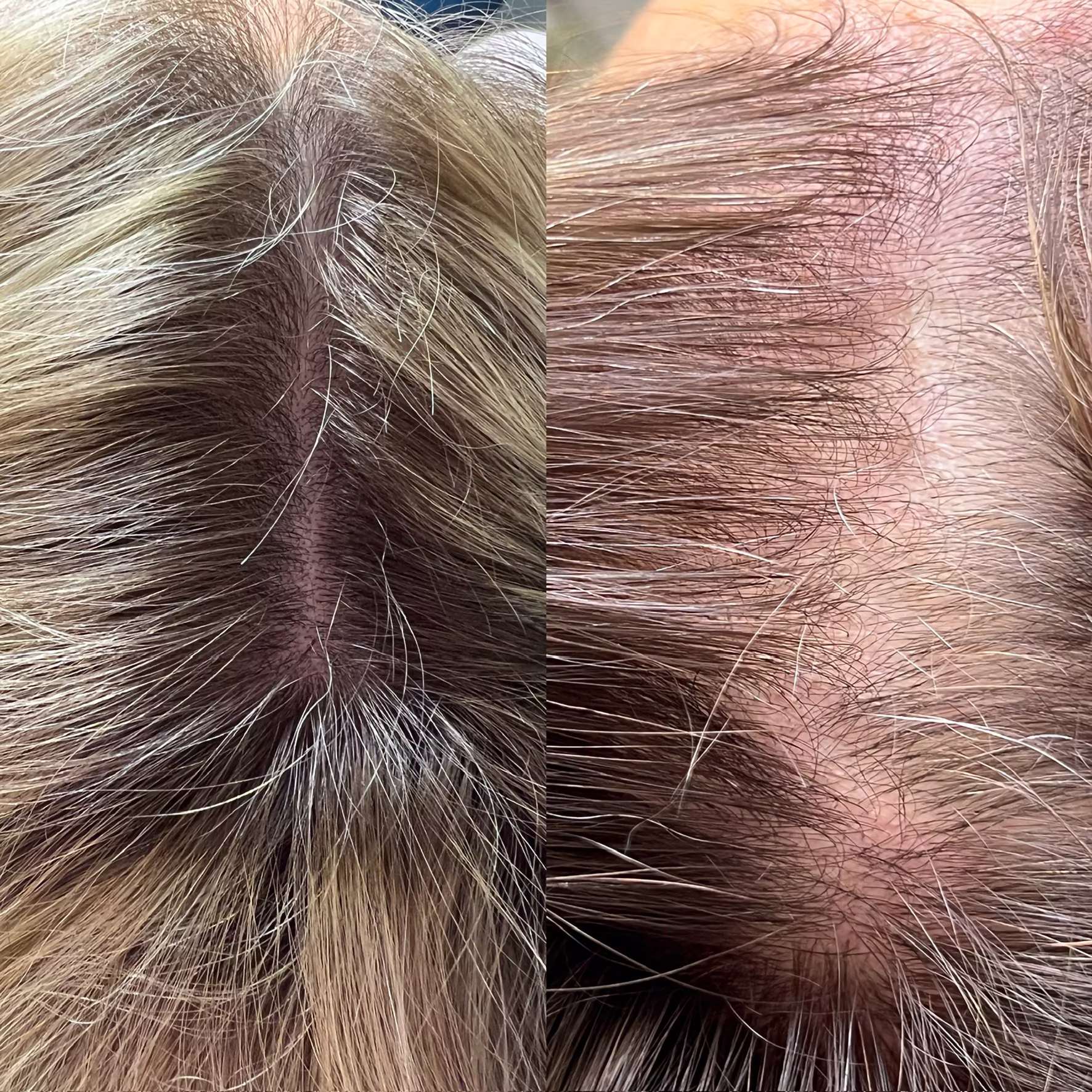 Zagęszczenie włosów po serii zabiegów mezoterapii igłowej i stymulatorów skóry głowy. Widoczny odrost nowych włosów i poprawa kondycji cebulek u Klientki w Poznaniu.