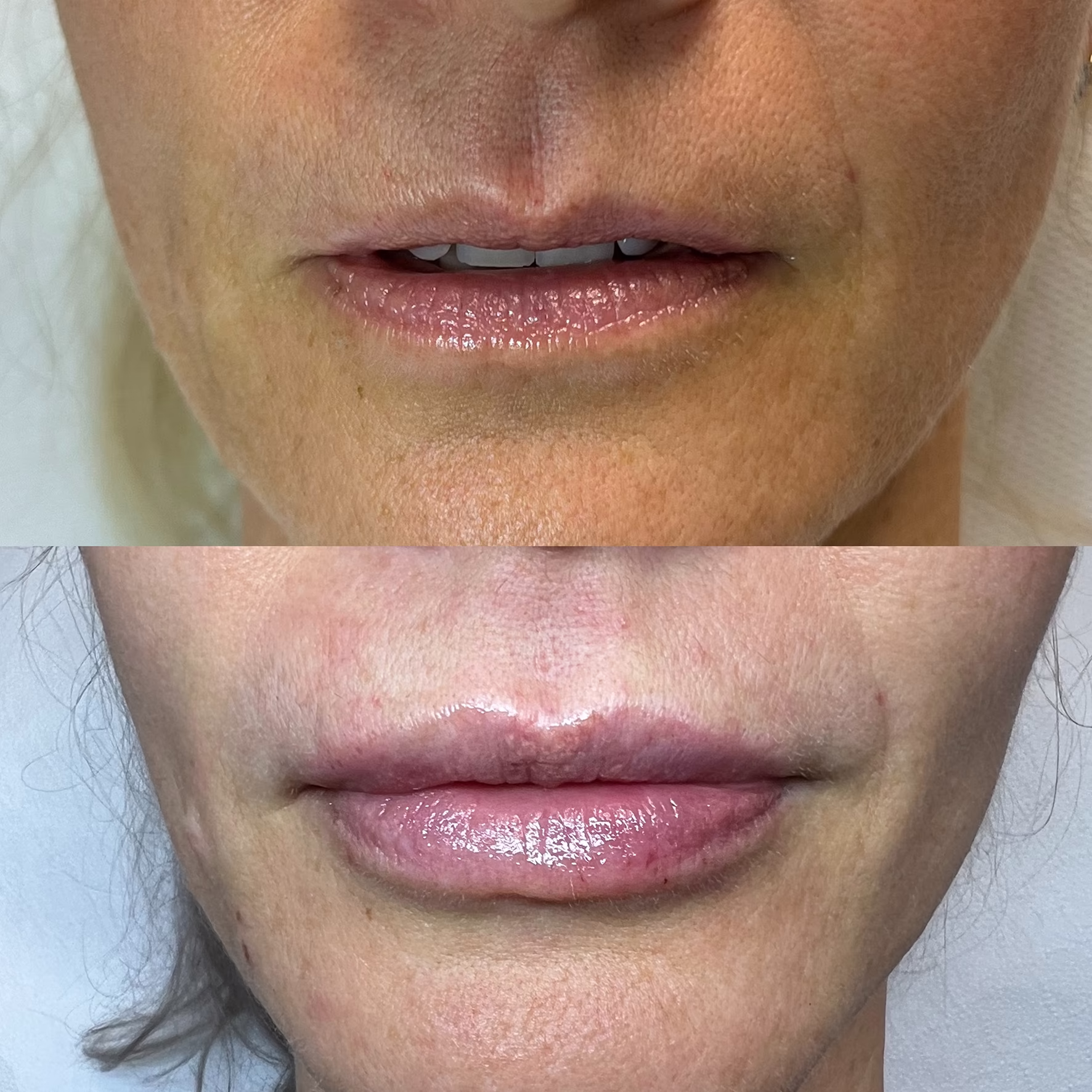 Korekta asymetrii i naturalne powiększenie ust kwasem hialuronowym. Porównanie przed i po zabiegu: usta nawilżone, o harmonijnym kształcie i subtelnej objętości.