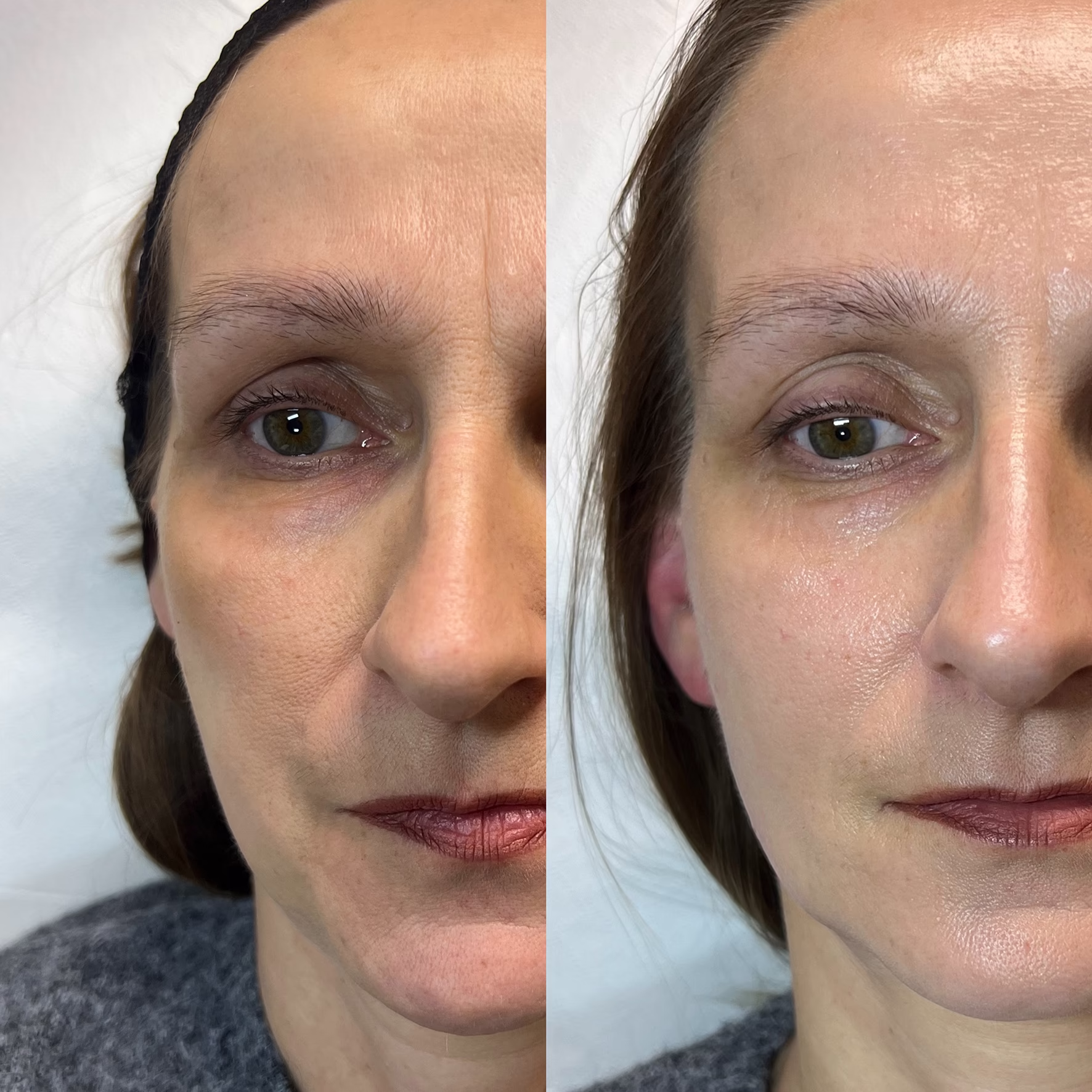 Korekta proporcji twarzy i lifting objętościowy. Widoczna poprawa napięcia skóry i harmonizacja rysów po zabiegu wolumetrii w gabinecie Malendowska Aesthetic.