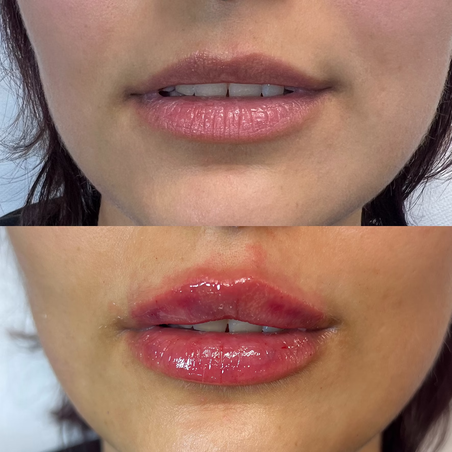 Efekt powiększania ust techniką »na płasko« bezpośrednio po zabiegu. Naturalna objętość, wyrównanie asymetrii i podkreślony łuk Kupidyna — metamorfoza w Poznaniu