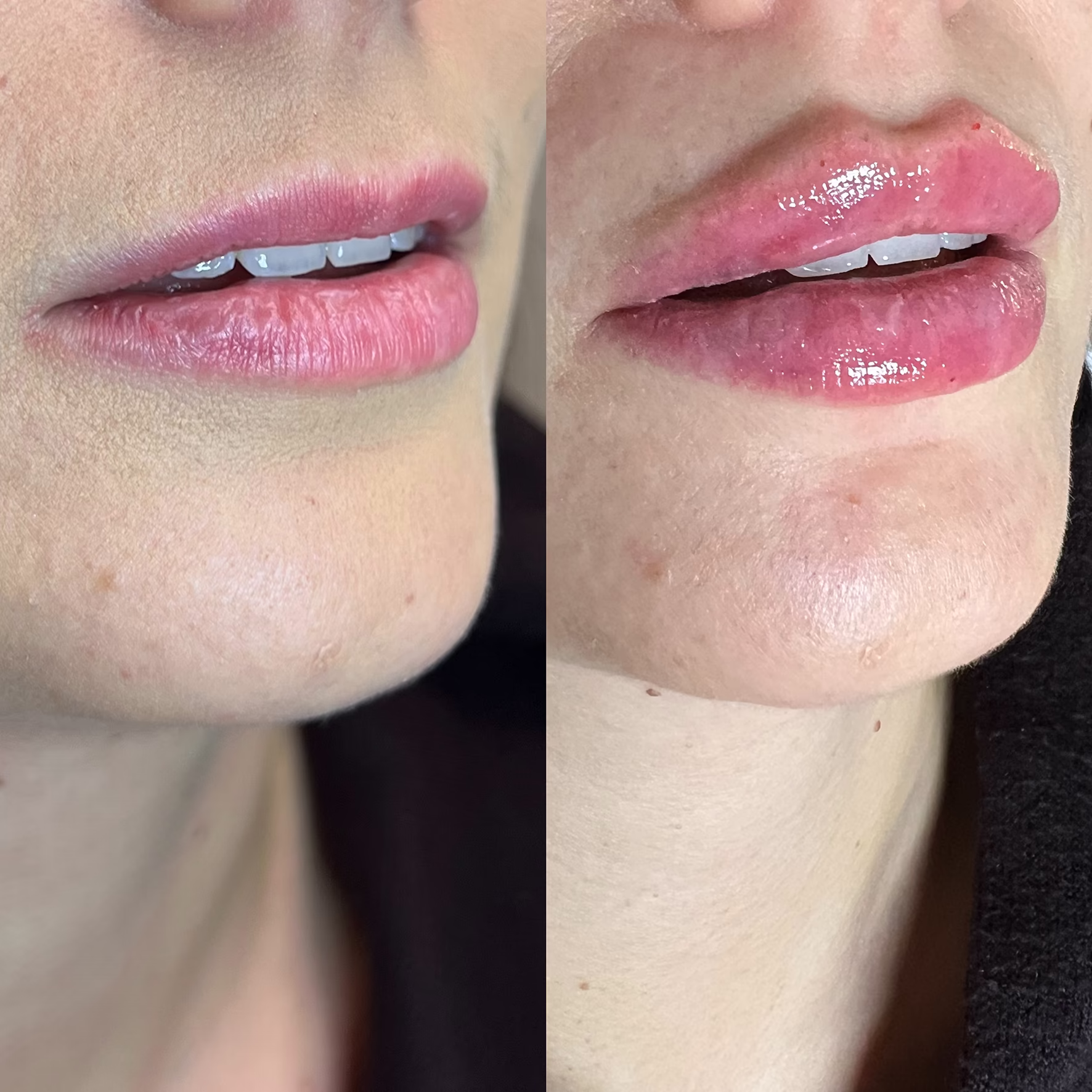 Naturalny profil po modelowaniu ust kwasem hialuronowym. Efekt uwydatnienia czerwieni wargowej z zachowaniem prawidłowych proporcji w gabinecie Malendowska Aesthetic w Poznaniu