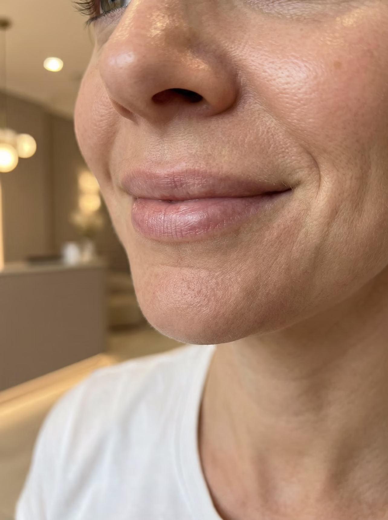 Naturalny profil ust po modelowaniu kwasem hialuronowym. Efekt techniki na płasko bez nienaturalnego uwypuklenia w gabinecie Malendowska Aesthetic