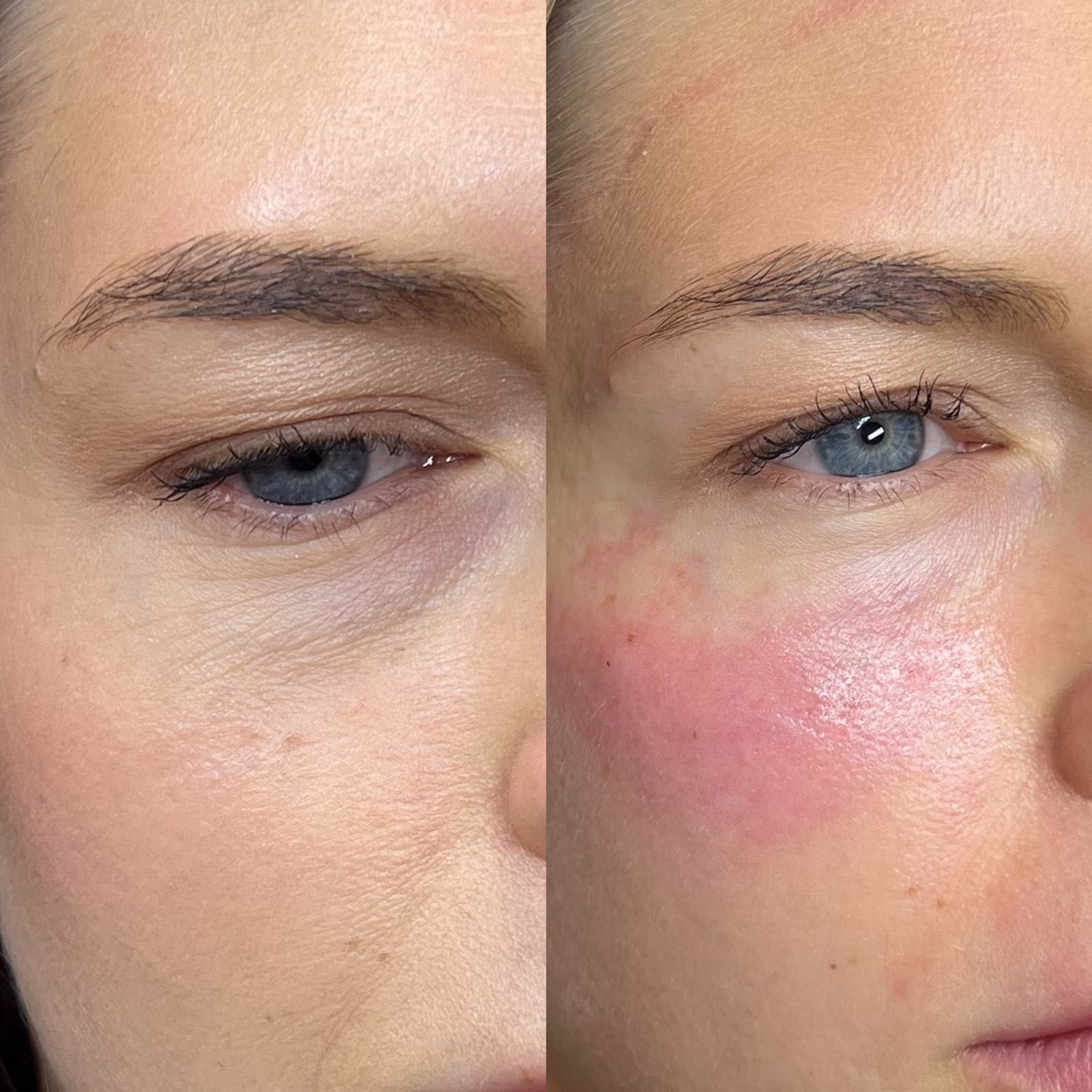 Efekt rewitalizacji i zagęszczenia skóry pod okiem za pomocą nici PDO. Porównanie przed i bezpośrednio po zabiegu – widoczne napięcie tkanki i naturalna reakcja pozabiegowa.