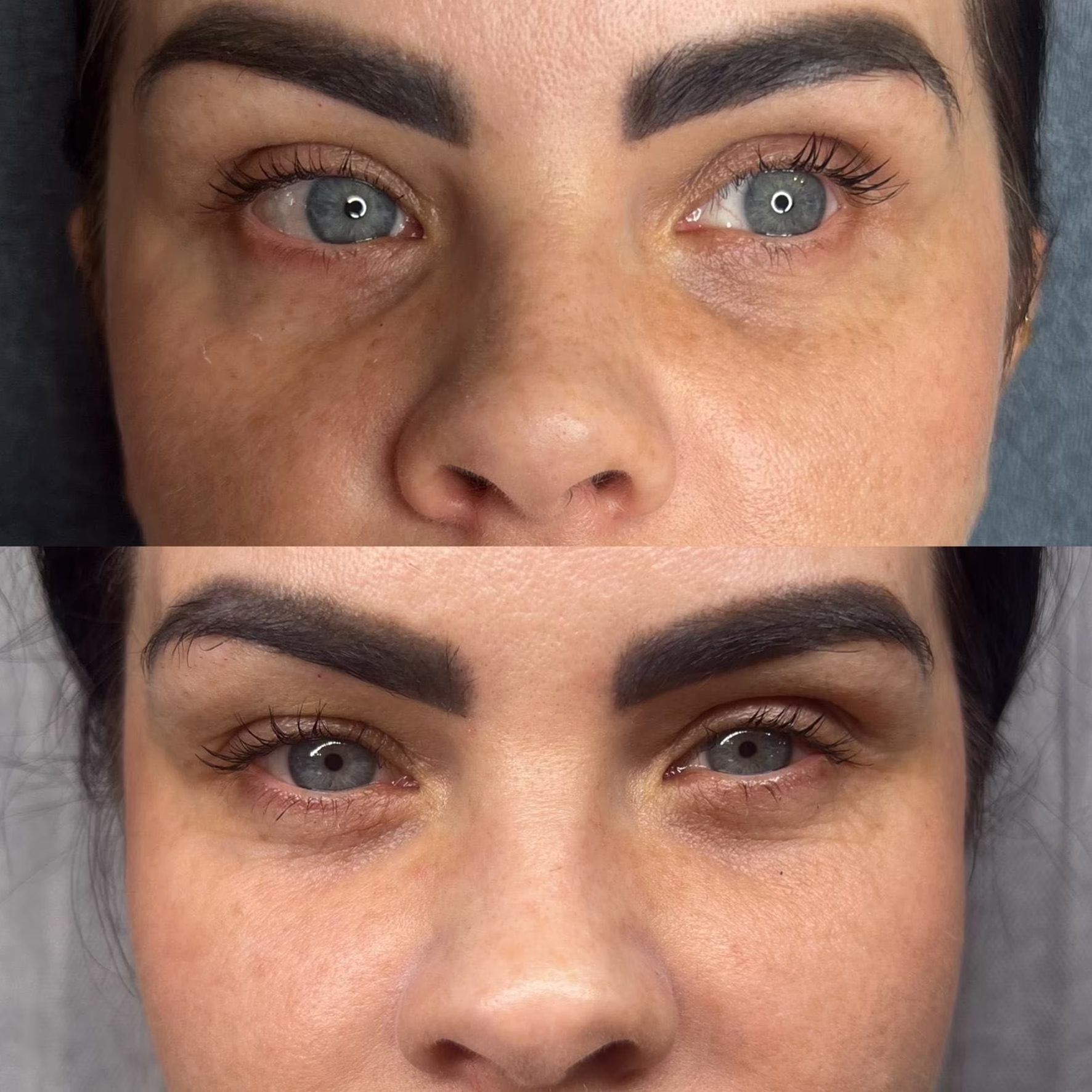 Zagęszczenie wiotkiej skóry pod oczami nićmi rewitalizującymi. Metamorfoza: widoczna redukcja drobnych zmarszczek i poprawa struktury skóry pod dolną powieką