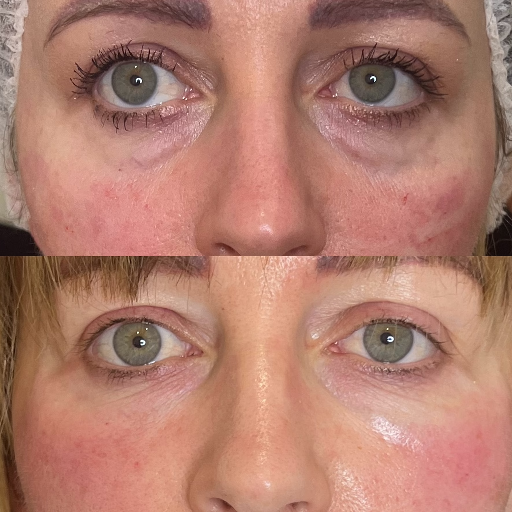 Efekt stymulatorów tkankowych pod oczy. Widoczna redukcja cieni, wypełnienie doliny łez i rozświetlenie spojrzenia przed i po zabiegu w Poznaniu.