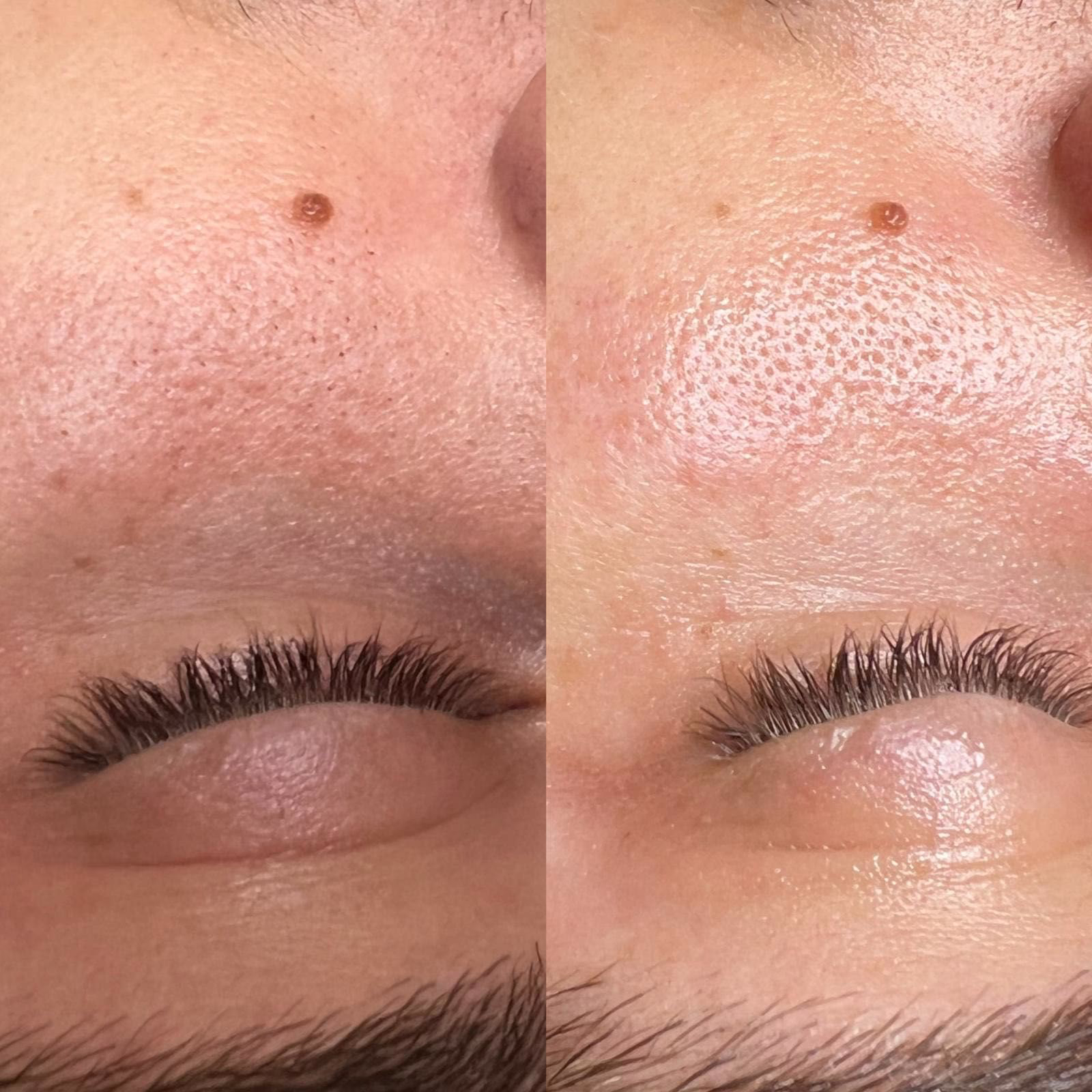 Zbliżenie policzek przed i po zabiegu oczyszczającym. Widoczne odblokowanie porów oraz wygładzenie struktury skóry dzięki terapii wodorowej