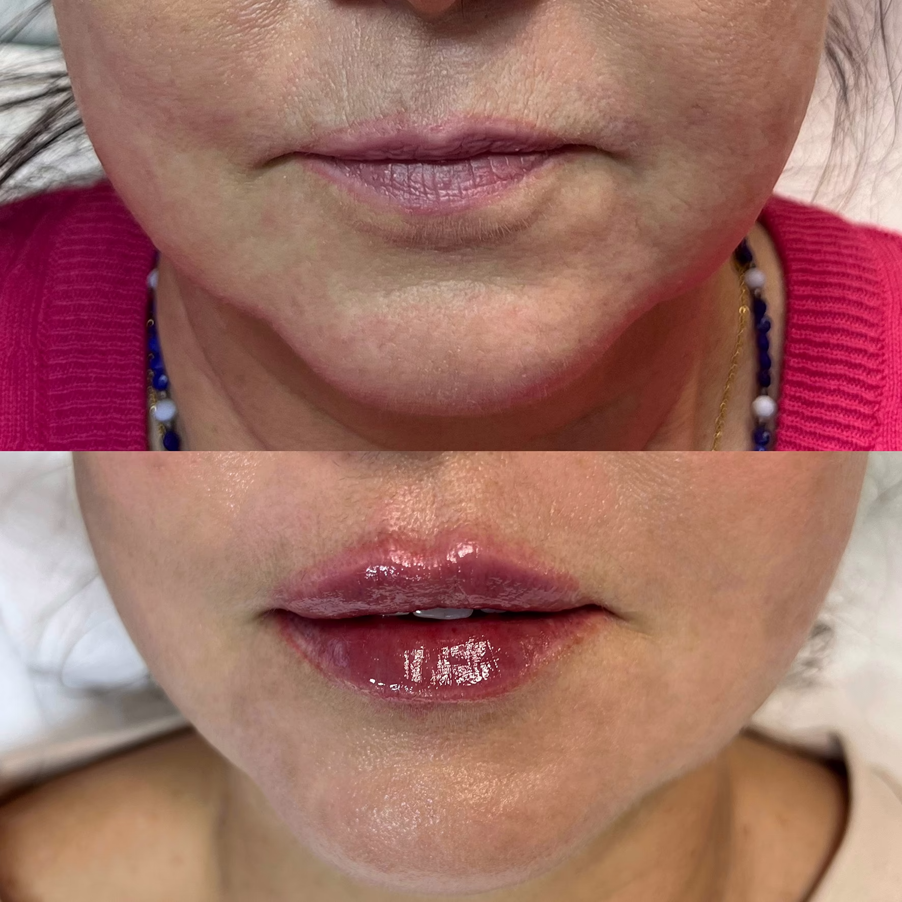 Odmładzanie i nawilżanie ust u osoby dojrzałej. Porównanie przed i po: redukcja zmarszczek wokół ust, przywrócenie naturalnego kolorytu i objętości warg.