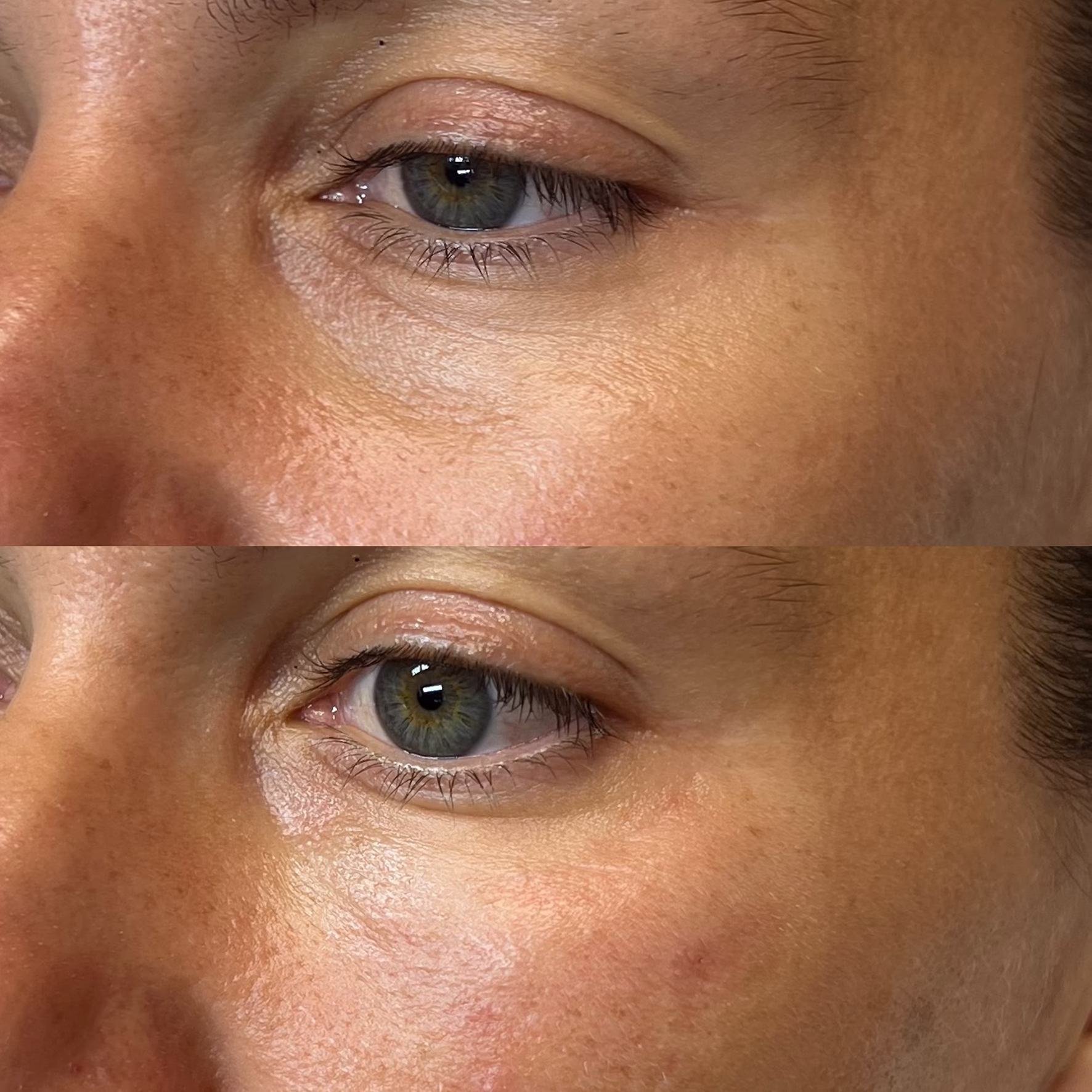 Redukcja drobnych zmarszczek i ceni wokół oczu dzięki biostymulacji. Porównanie przed i po zabiegu poprawiającym strukturę i elastyczność cienkiej skóry powiek.