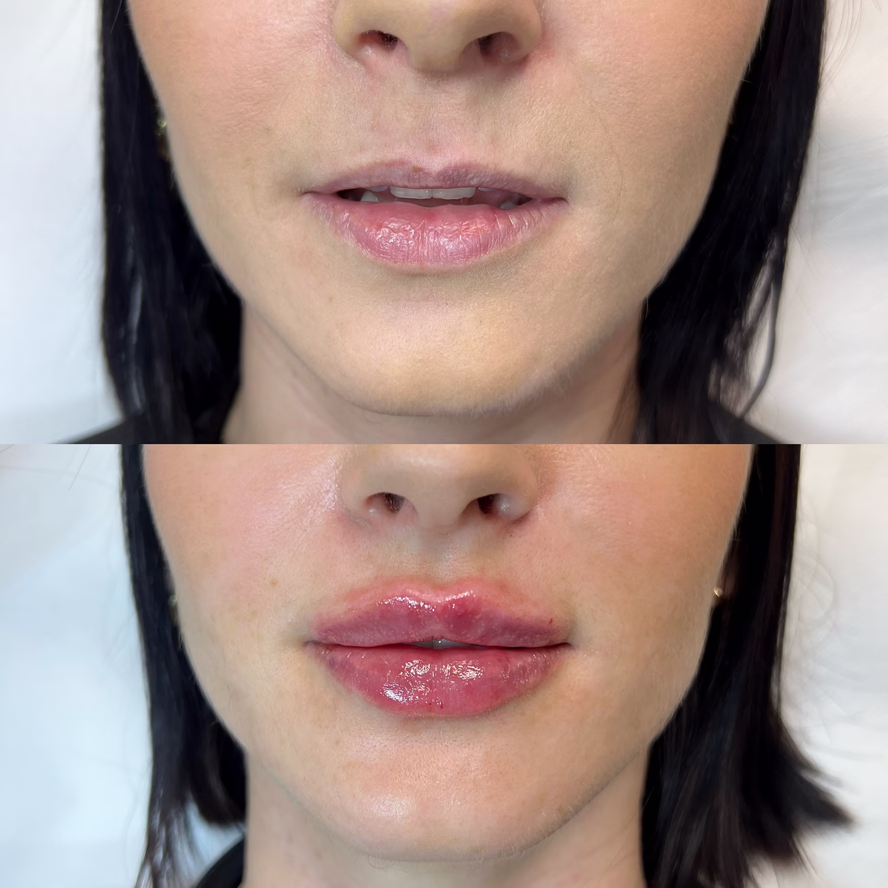 Efekt powiększania ust techniką »na płasko« bezpośrednio po zabiegu. Porównanie przed i po: wyrównanie asymetrii, podkreślenie konturu i naturalne odświeżenie wyglądu twarzy.