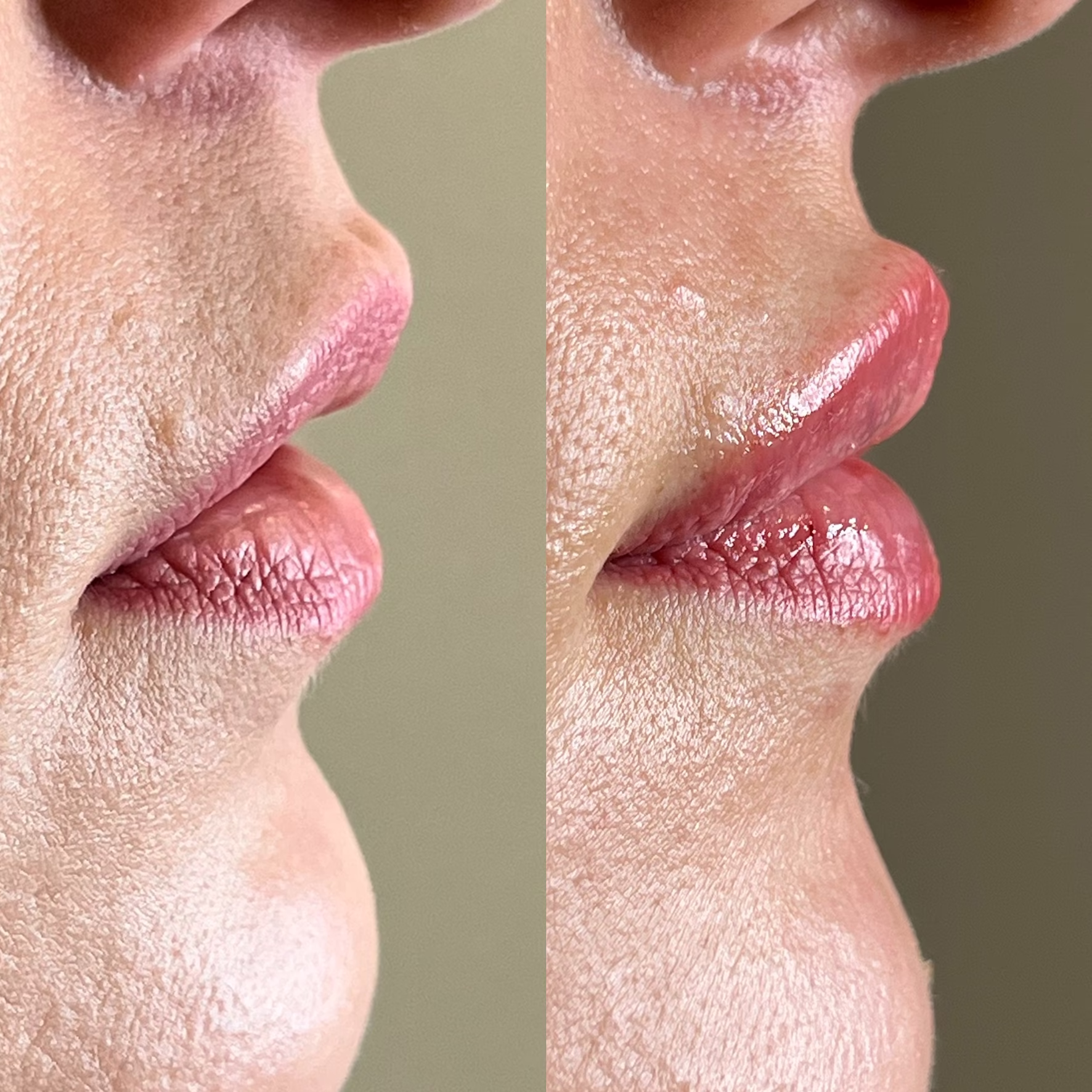 Modelowanie ust techniką na płasko – widok z profilu. Widoczna poprawa proporcji warg bez nienaturalnego uwypuklenia. Precyzyjna praca z kwasem hialuronowym.