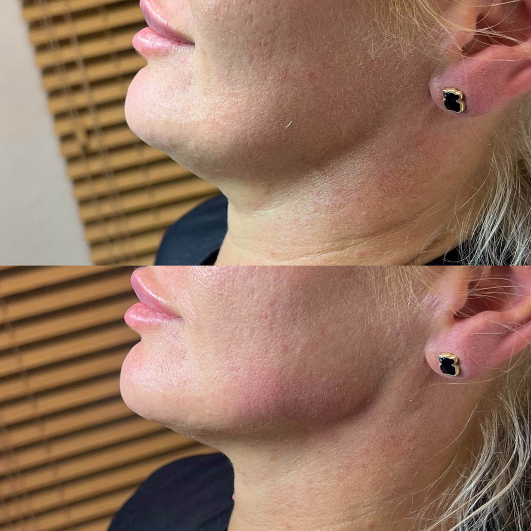 Redukcja tzw. „chomików” i poprawa linii żuchwy. Porównanie przed i po zabiegu wolumetrii, który przywrócił naturalne podparcie tkanek dolnego piętra twarzy.