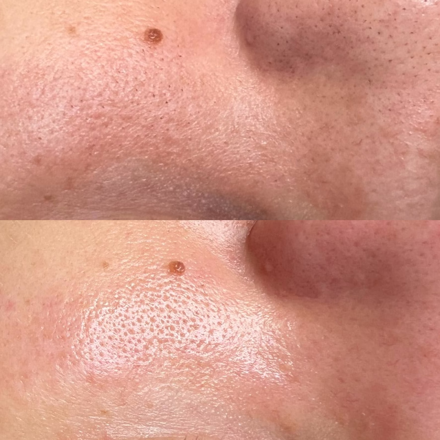 Zbliżenie na nos i policzek przed i po zabiegu oczyszczającym. Widoczna redukcja zaskórników, odblokowanie porów oraz wygładzenie struktury skóry dzięki terapii wodorowej