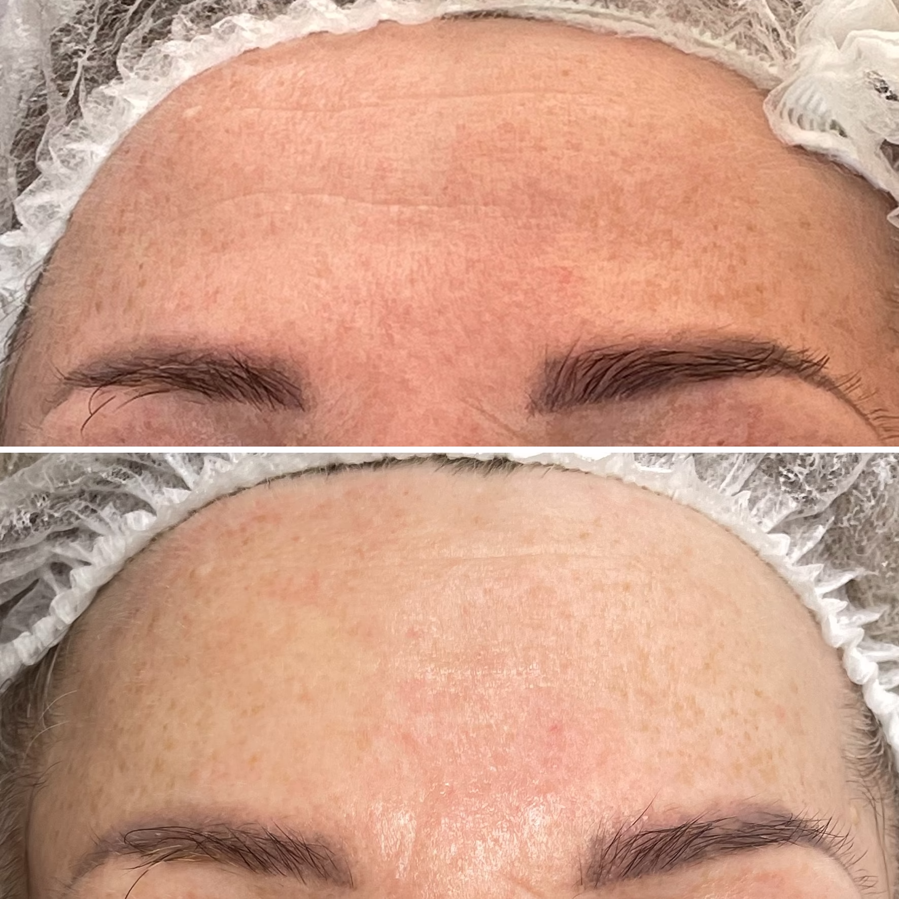 Poprawa struktury i tekstury skóry czoła. Redukcja przebarwień i efekt gładkiej skóry po zabiegu Dermapen w gabinecie Malendowska Aesthetic