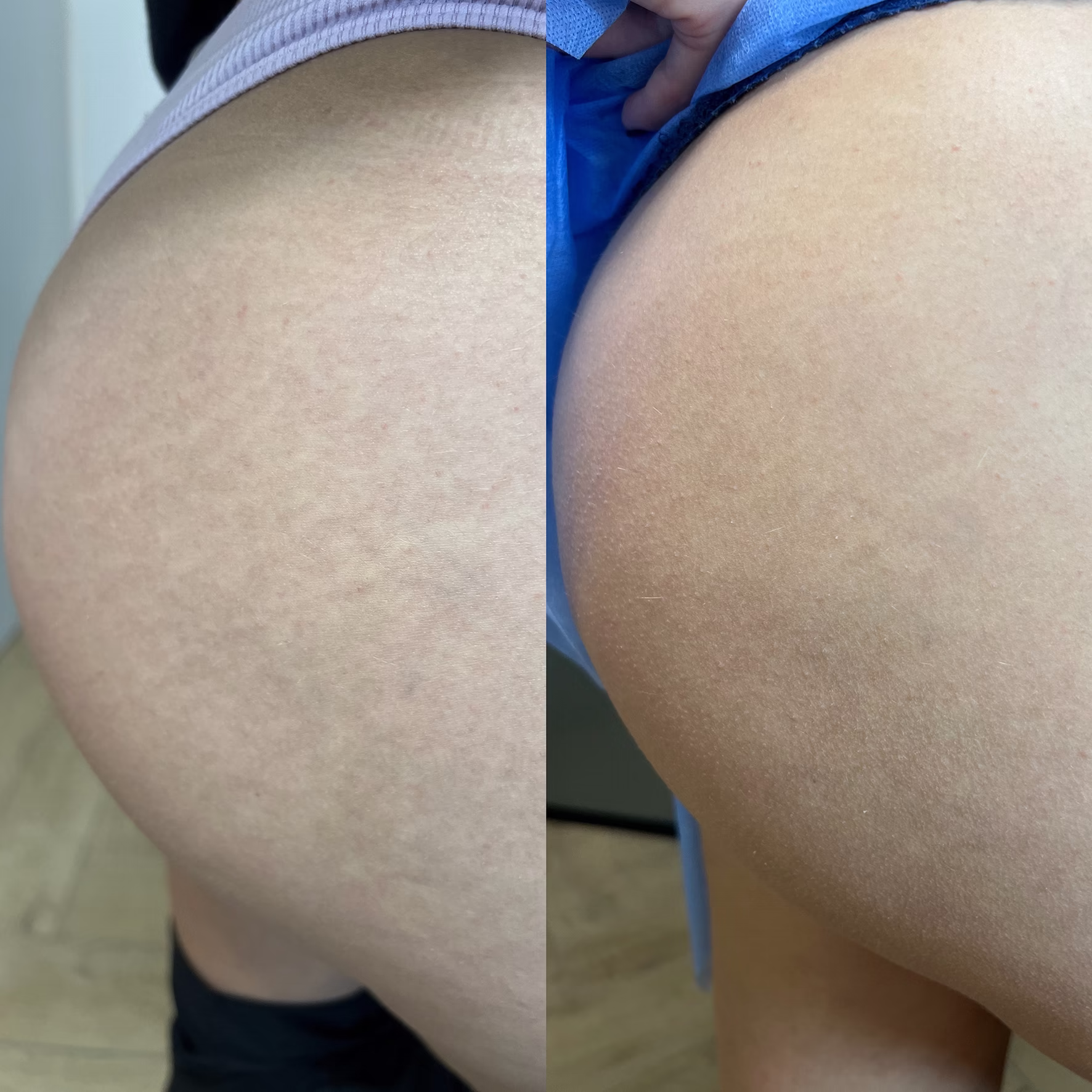 Redukcja rozstępów i ujędrnienie skóry pośladków. Efekt przebudowy strukturalnej i zagęszczenia tkanki po zabiegach nieablacyjnym laserem Er:Glass.