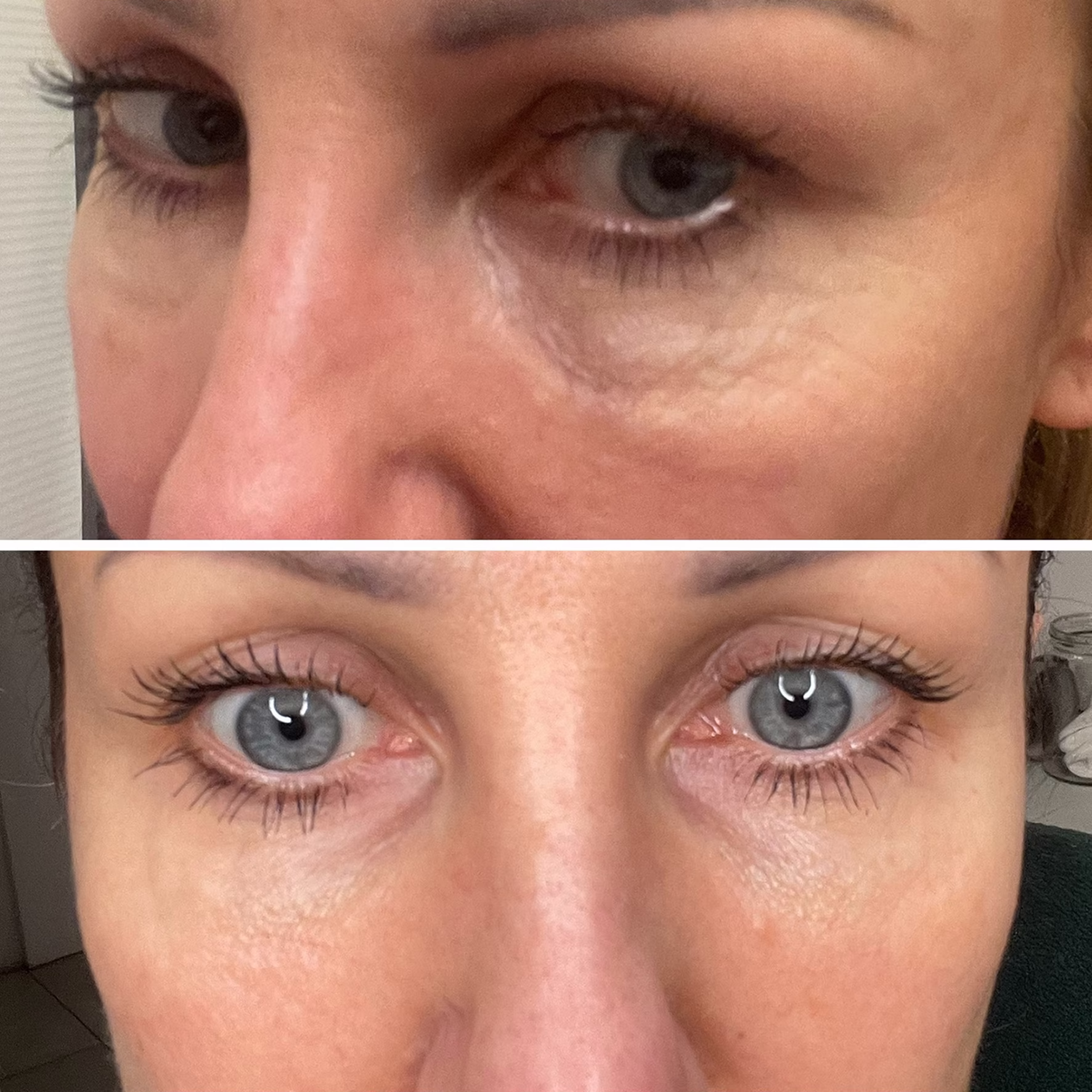 Redukcja cieni pod oczami i wypełnienie doliny łez. Odświeżone spojrzenie i redukcja zmęczenia - efekt zabiegu estetycznego.