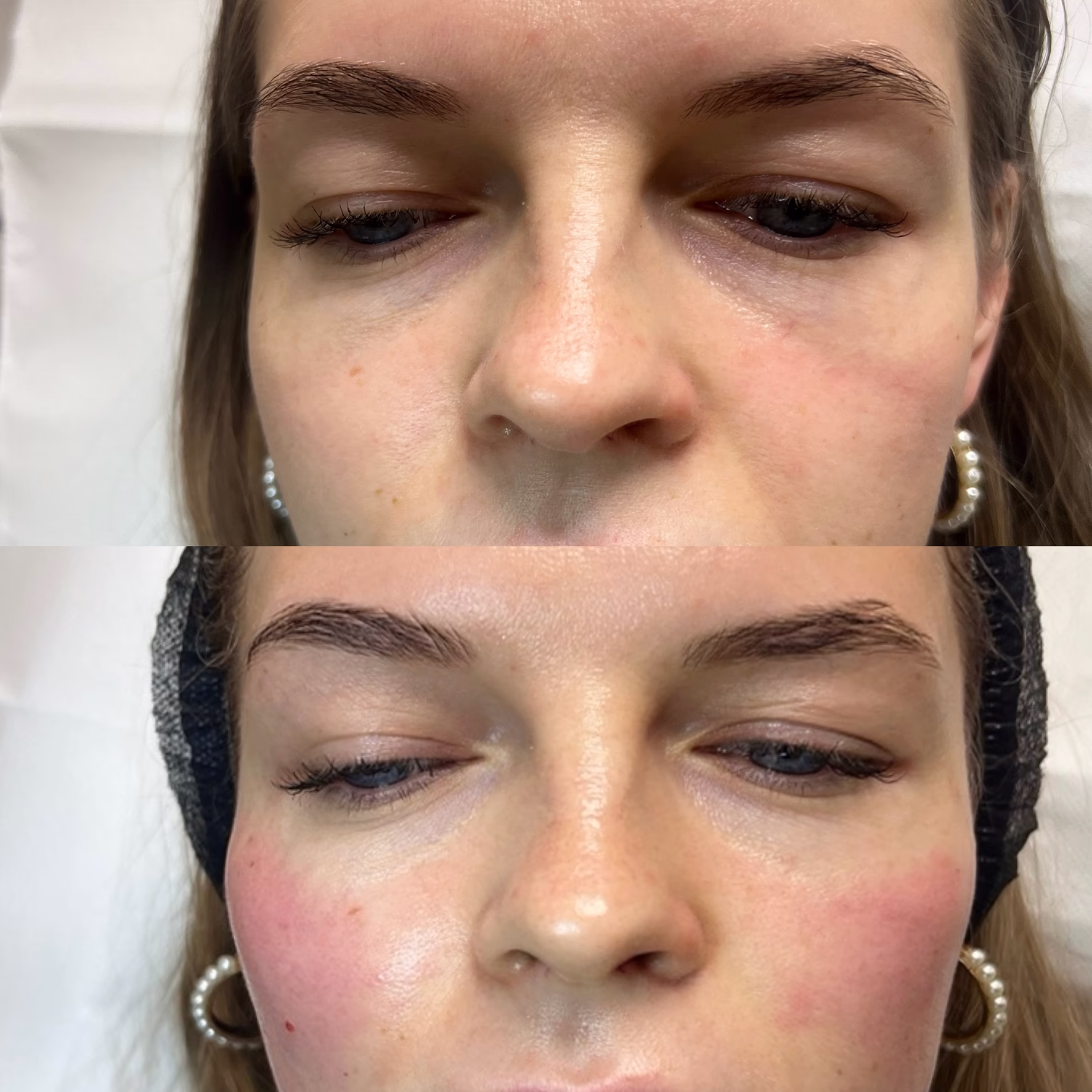 Rewitalizacja skóry pod oczami stymulatorem tkankowym. Porównanie przed i po: rozjaśnienie cieni, nawilżenie doliny łez i wygładzenie drobnych zmarszczek mimicznych.