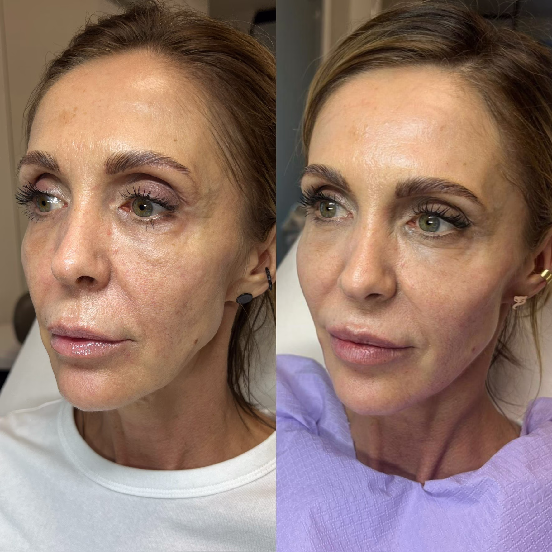 Spektakularny efekt terapii łączonej (laseroterapia i stymulatory tkankowe). Całościowe odmłodzenie twarzy, uniesienie owalu i poprawa napięcia skóry u dojrzałej osoby.