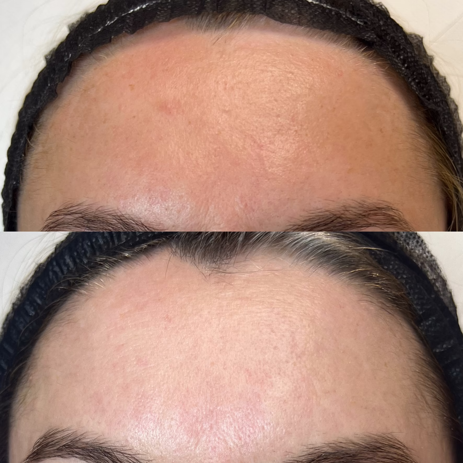 Skóra czoła przed zabiegiem laserowym. Widoczne rozszerzone pory i nierówna struktura naskórka. Efekt wygładzenia czoła i redukcji porów po 1 zabiegu laserem GentleFrax PRO (Tulowy + Er:Glass). Skóra rozświetlona.