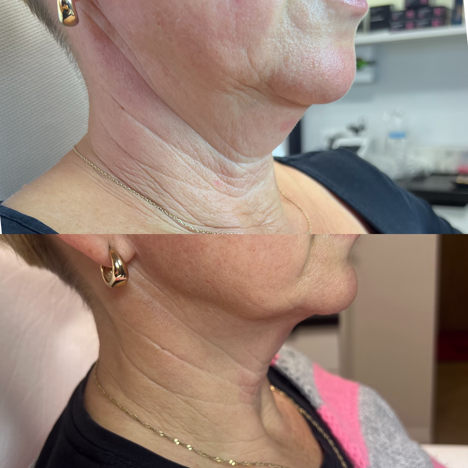 Redukcja wiotkości skóry podbródka i ujędrnienie profilu twarzy. Efekt silnej biostymulacji kolagenu kwasem polimlekowym w gabinecie Malendowska Aesthetic