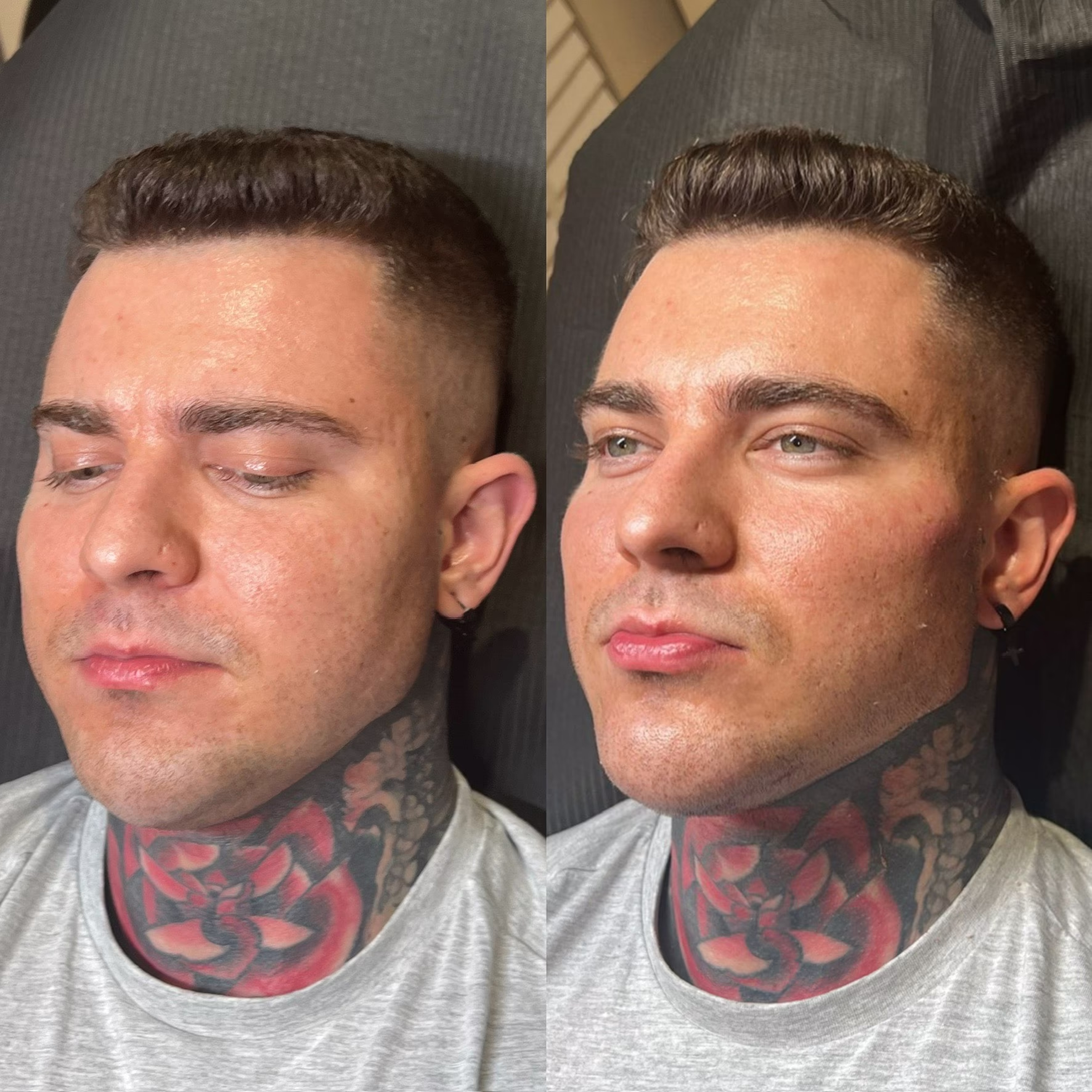 Wolumetria męska i modelowanie kątów żuchwy (Texas Jawline). Efekt wyostrzenia rysów twarzy i wzmocnienia linii brody u mężczyzny przed i po iniekcji.