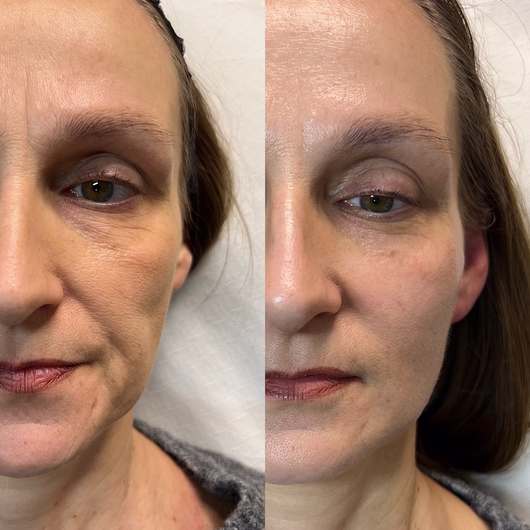 Podniesienie owalu twarzy i odbudowa objętości policzków kwasem hialuronowym. Naturalny efekt odświeżenia i redukcji bruzd nosowo-wargowych przed i po zabiegu.