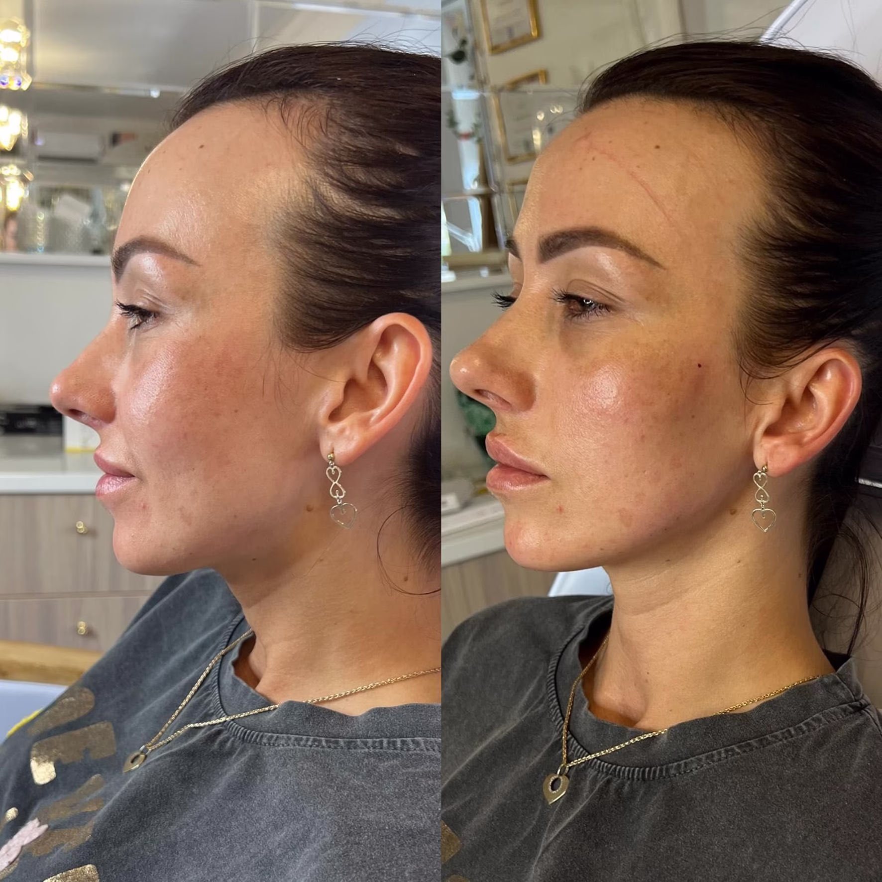 Efekt modelowania linii żuchwy i brody kwasem hialuronowym u kobiety. Wyraźne podkreślenie profilu i lifting dolnej partii twarzy przed i po zabiegu w Poznaniu.