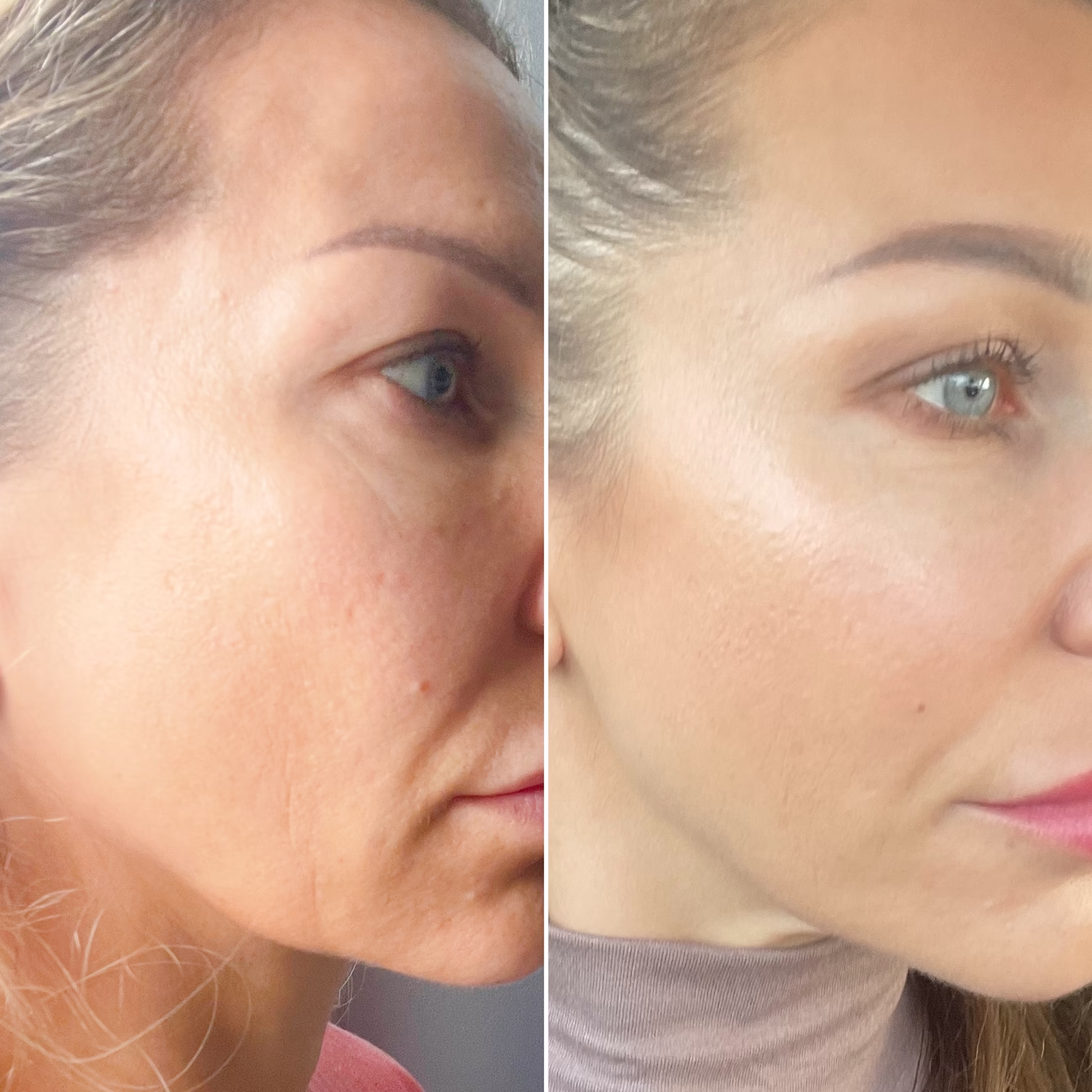 Metamorfoza skóry po zabiegu bankietowym. Porównanie przed i po: widoczne wygładzenie, rozświetlenie cery i efekt »glass skin« idealny pod makijaż w gabinecie Malendowska Aesthetic